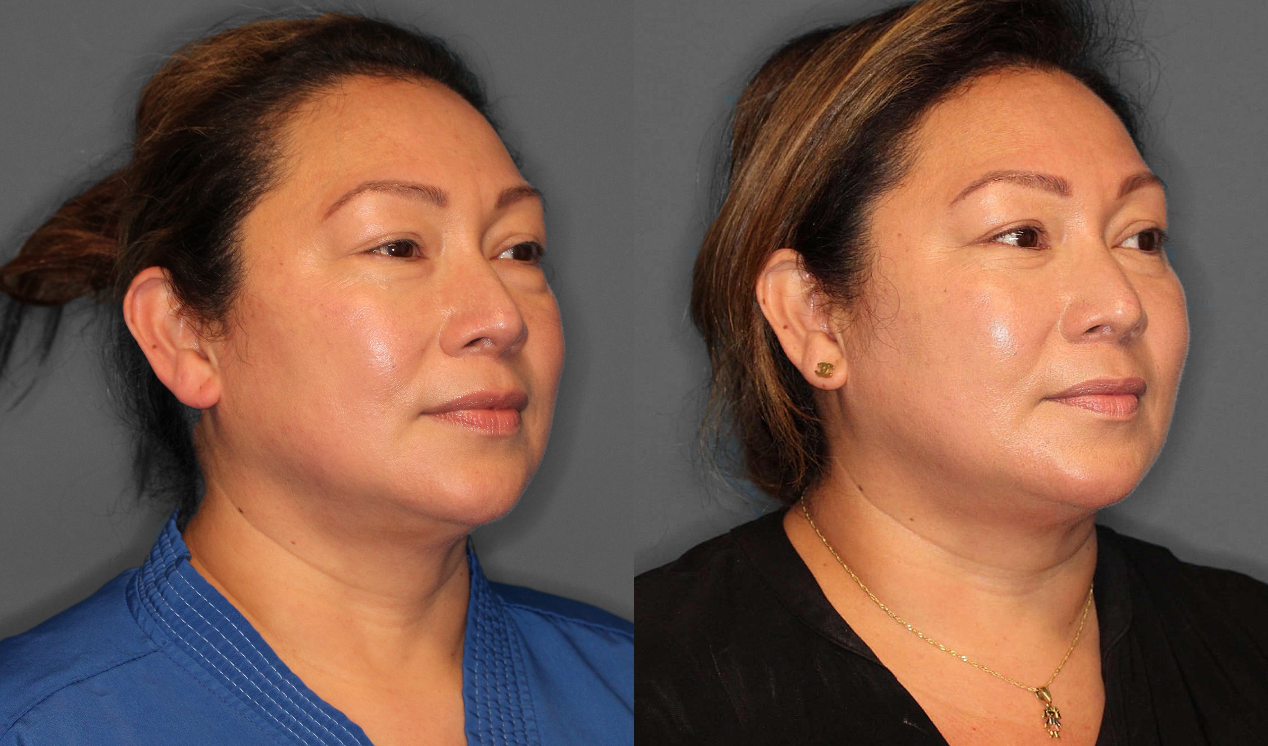 Lower Blepharoplasty Before and After photo by Dr. Abigail Rodriguez in Houston, TX