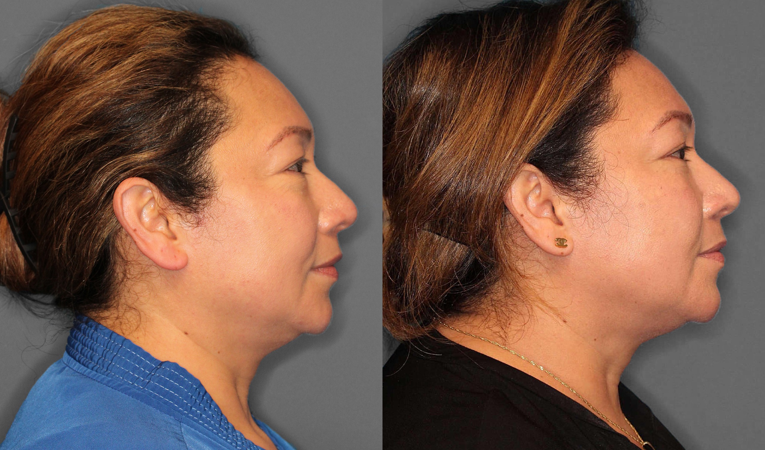 Lower Blepharoplasty Before and After photo by Dr. Abigail Rodriguez in Houston, TX