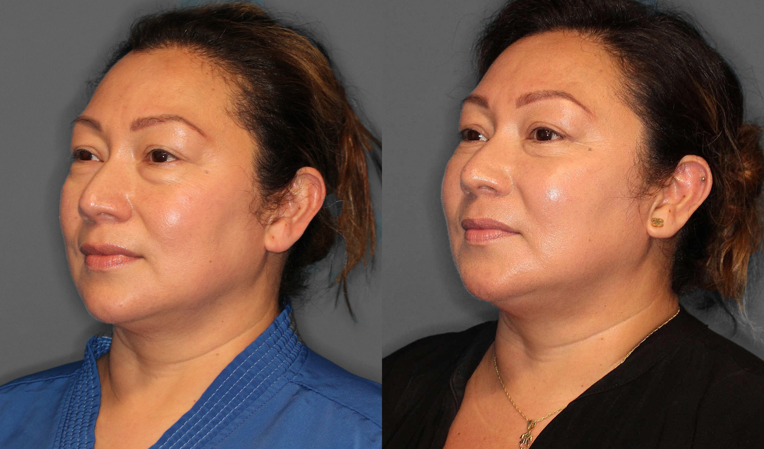 Lower Blepharoplasty Before and After photo by Dr. Abigail Rodriguez in Houston, TX