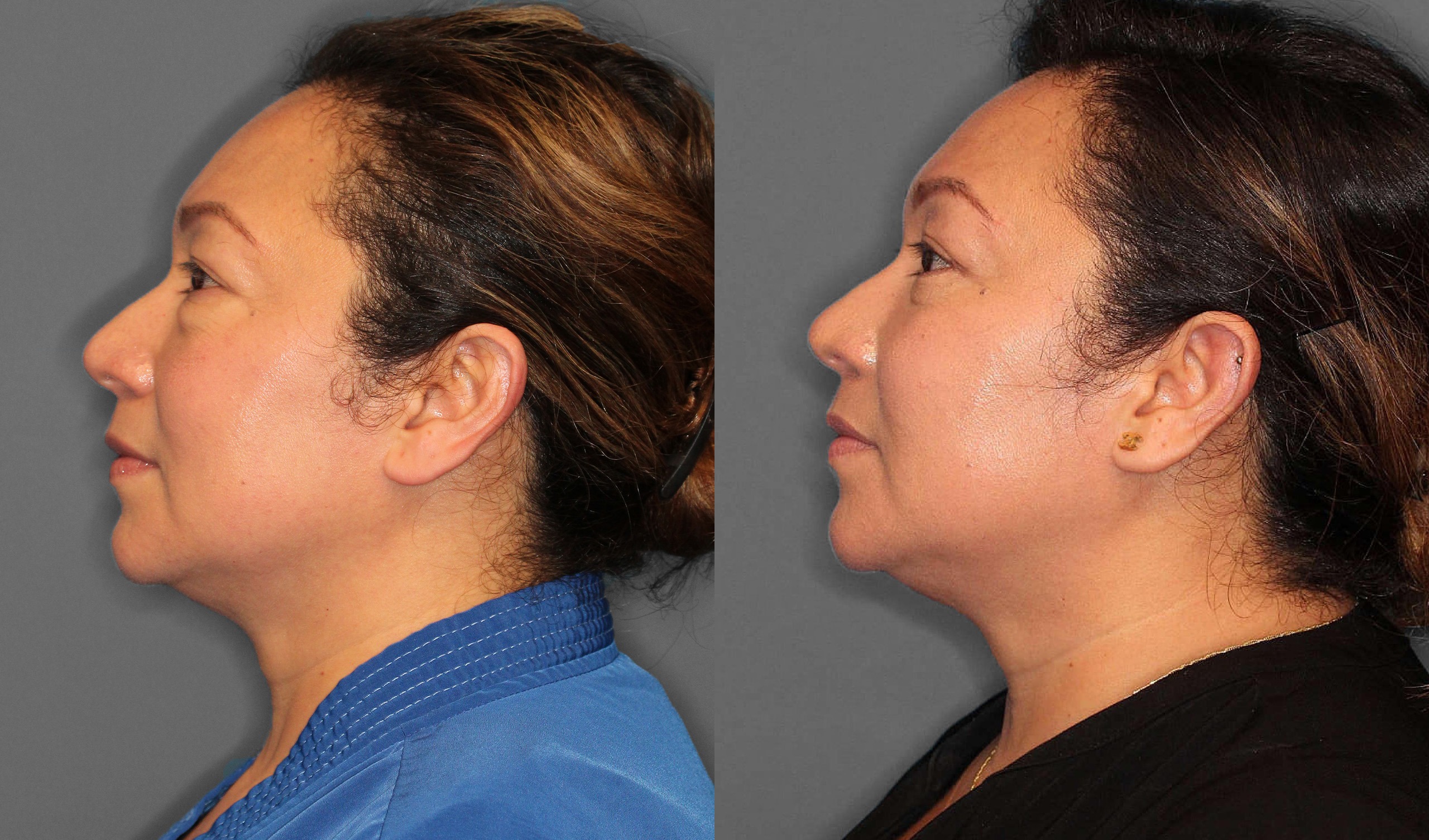Lower Blepharoplasty Before and After photo by Dr. Abigail Rodriguez in Houston, TX