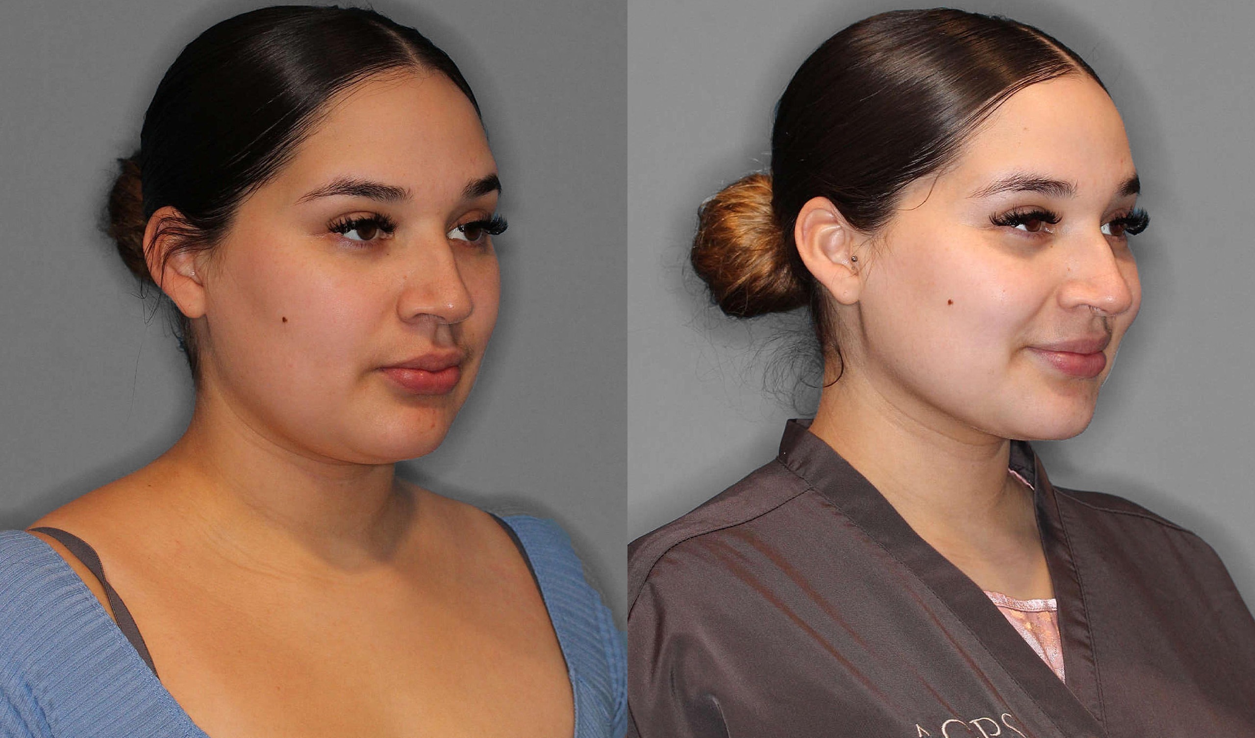 Neck Liposuction Before and After photo by Dr. Abigail Rodriguez in Houston, TX of
