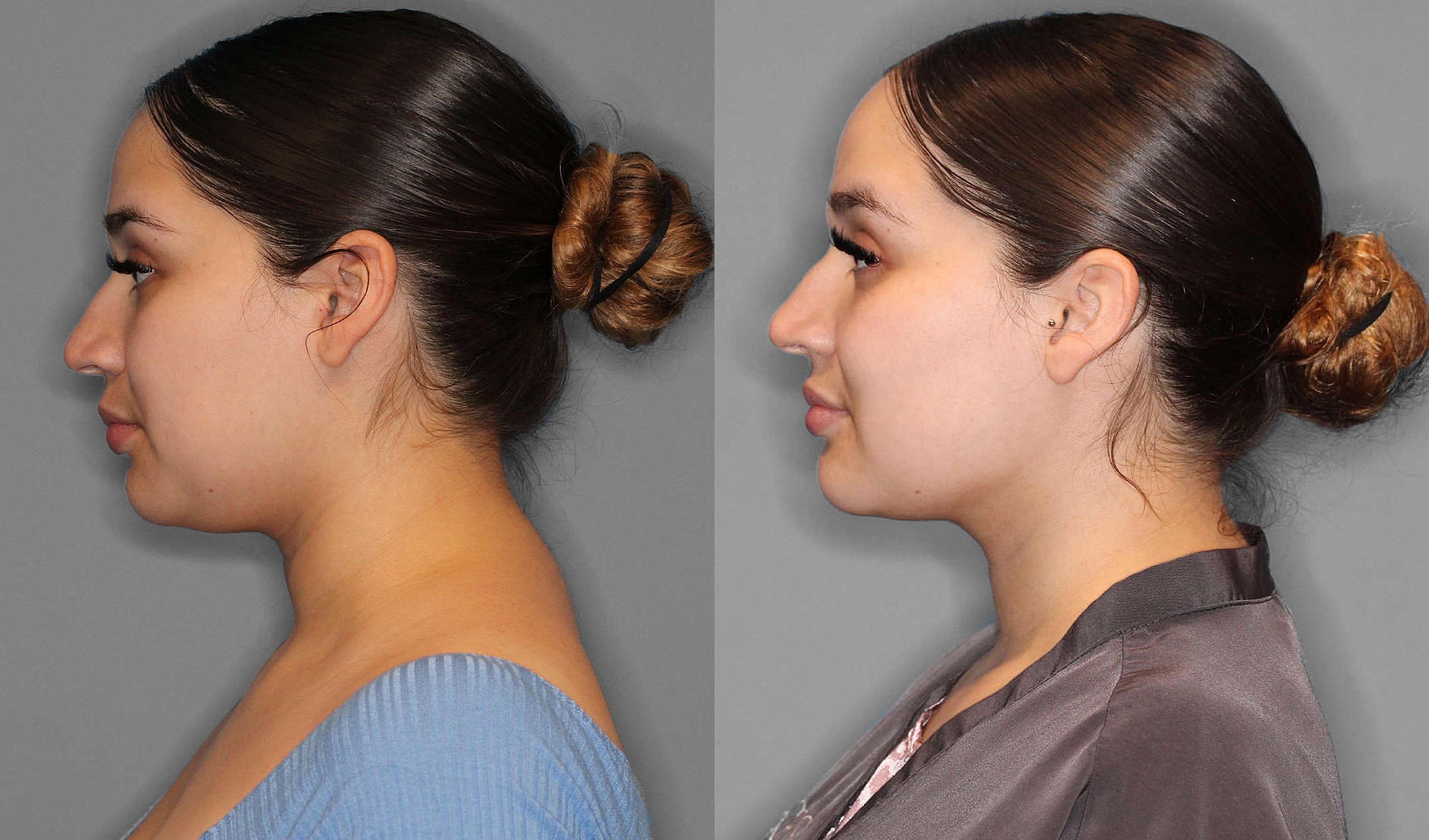Neck Liposuction Before and After photo by Dr. Abigail Rodriguez in Houston, TX