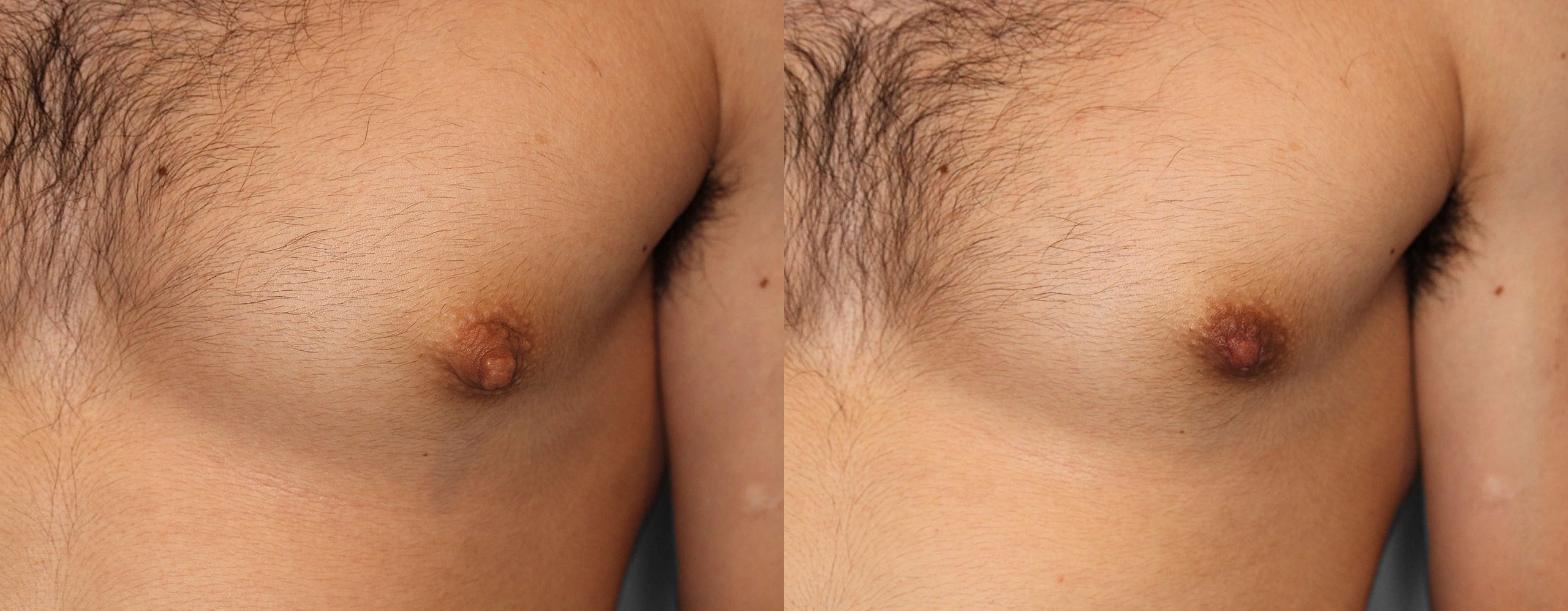 Nipple Reduction Before and After photo by Dr. Abigail Rodriguez in Houston, TX