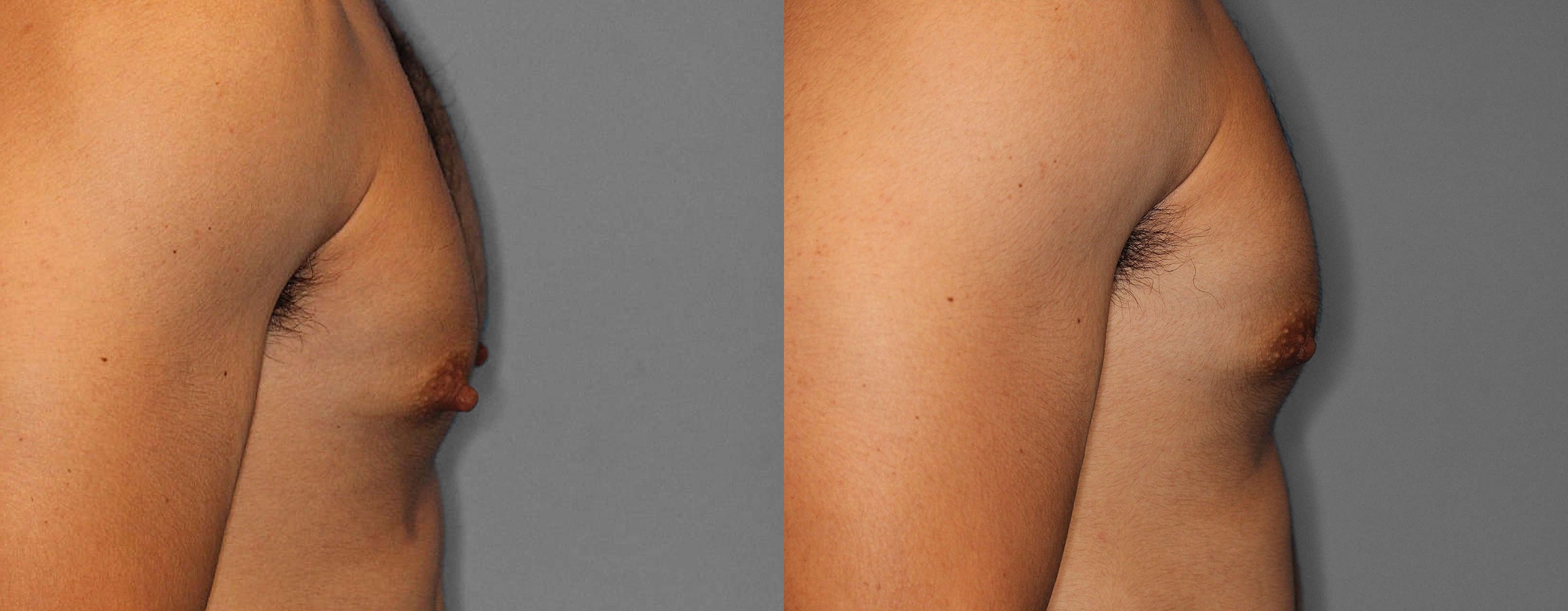 Nipple Reduction Before and After photo by Dr. Abigail Rodriguez in Houston, TX