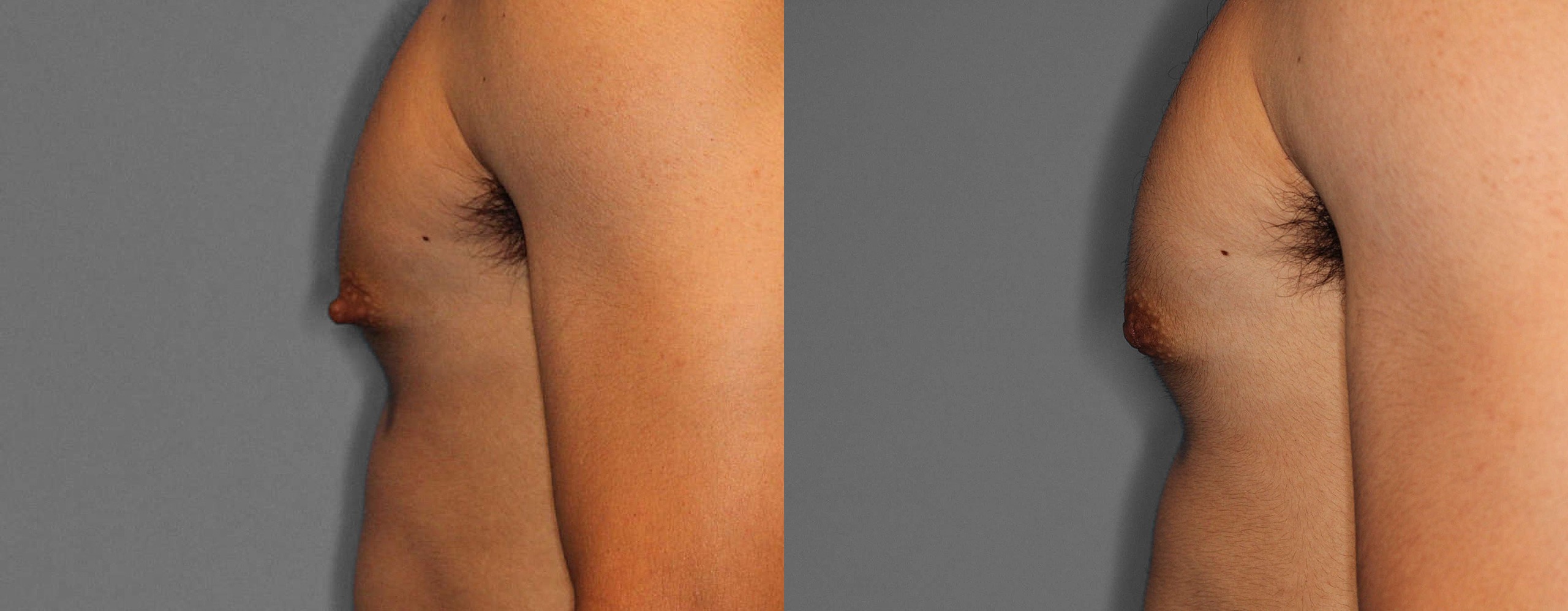 Nipple Reduction Before and After photo by Dr. Abigail Rodriguez in Houston, TX
