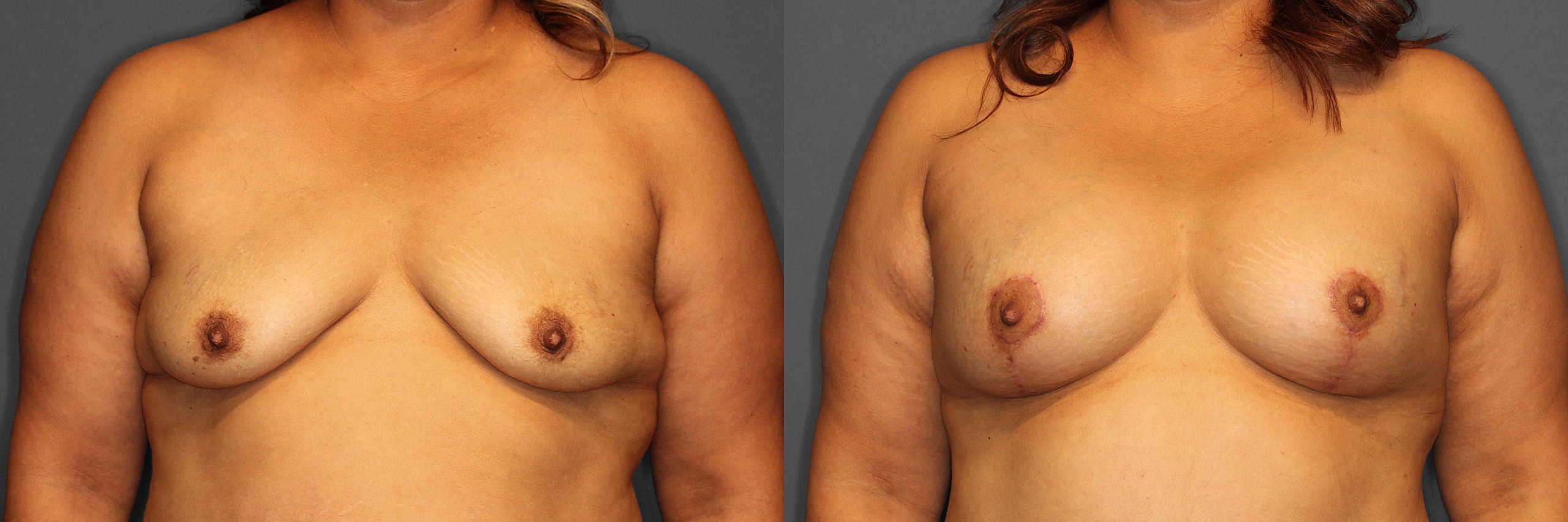 Breast Augmentation:Lift Before and After photo by Dr. Abigail Rodriguez in Houston, TX