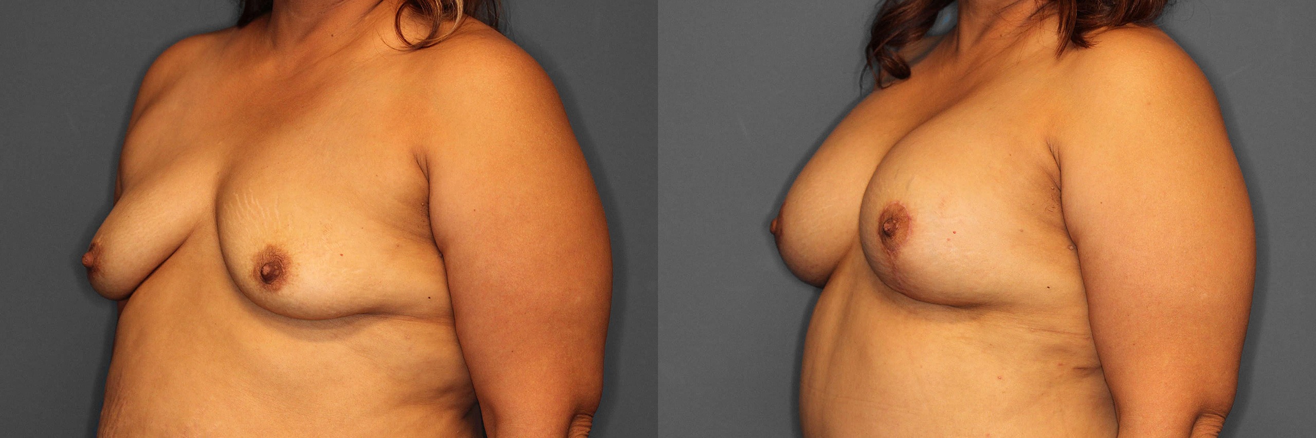 Breast Augmentation:Lift Before and After photo by Dr. Abigail Rodriguez in Houston, TX