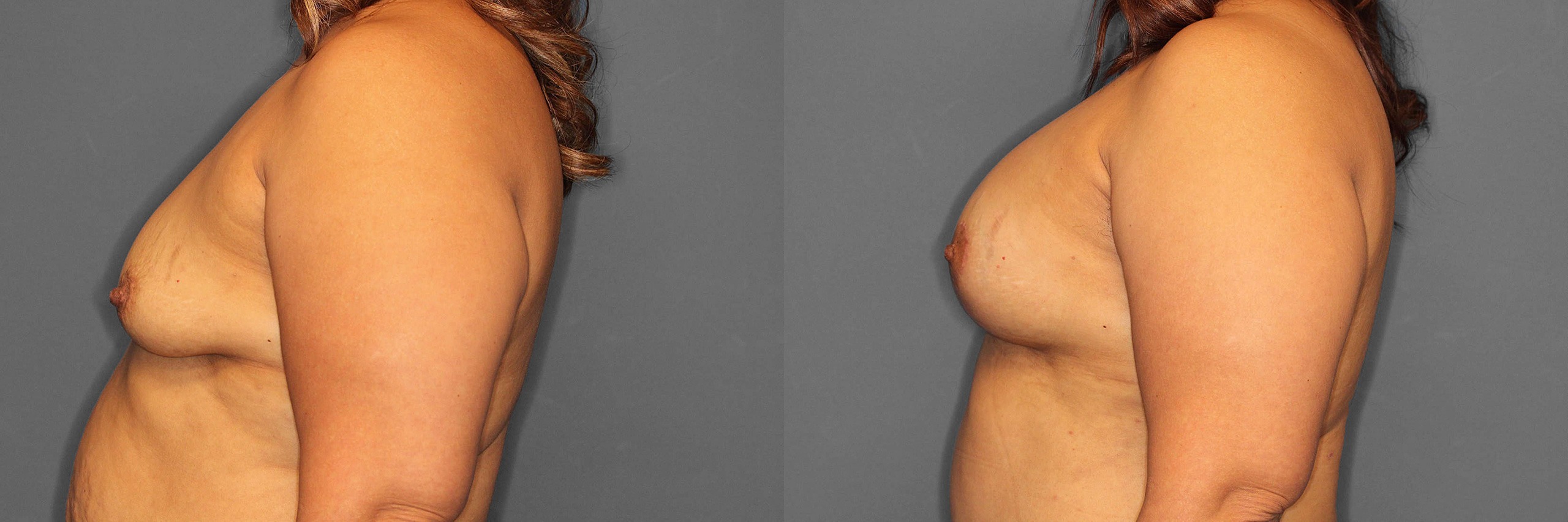 Breast Augmentation:Lift Before and After photo by Dr. Abigail Rodriguez in Houston, TX
