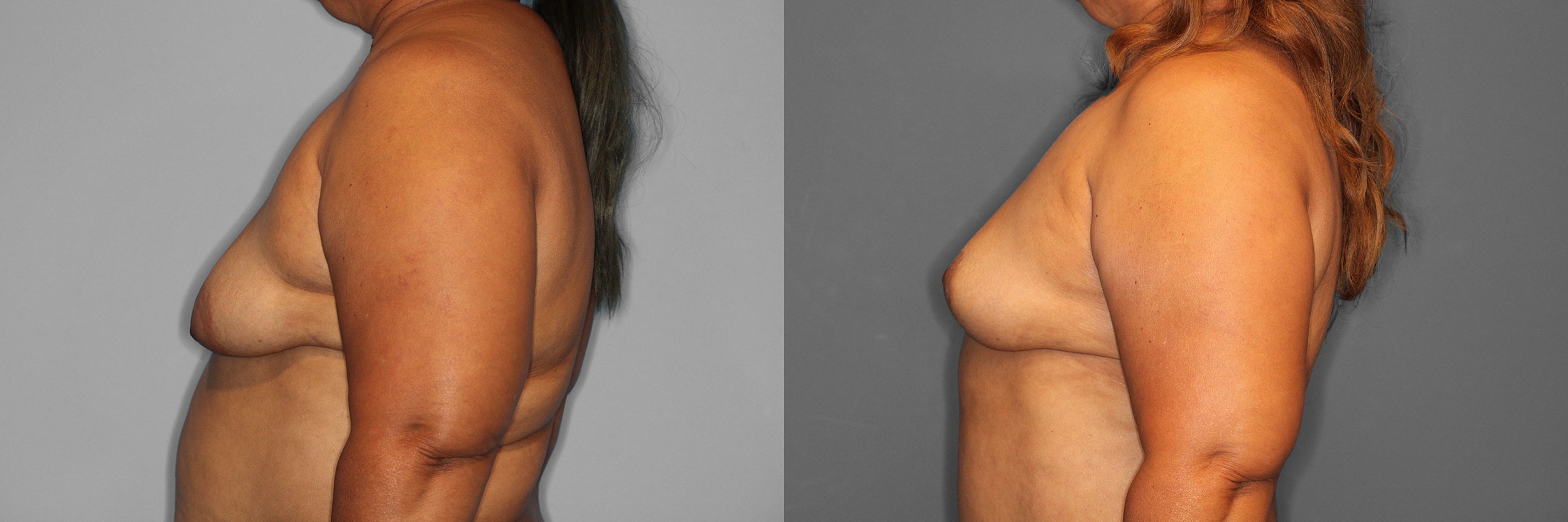 Breast Lift Before and After photo by Dr. Abigail Rodriguez in Houston, TX