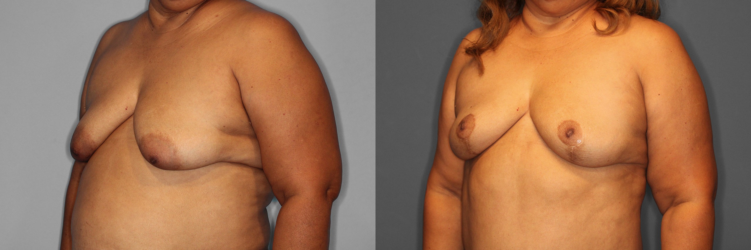 Breast Lift Before and After photo by Dr. Abigail Rodriguez in Houston, TX