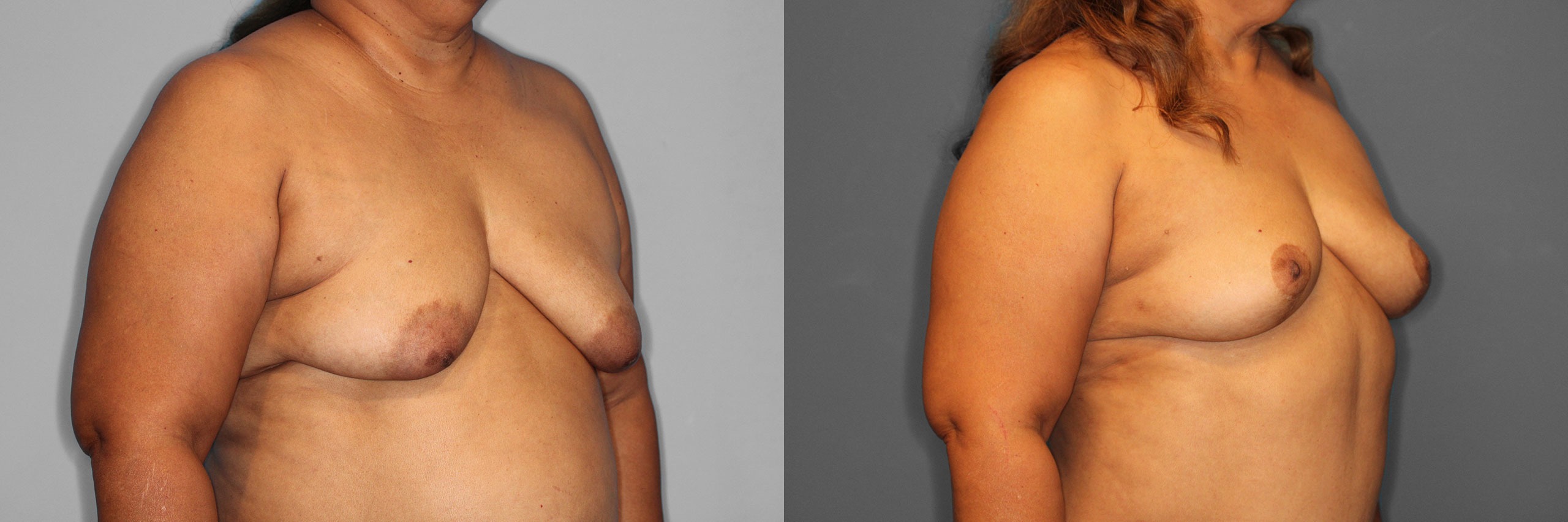 Breast Lift Before and After photo by Dr. Abigail Rodriguez in Houston, TX