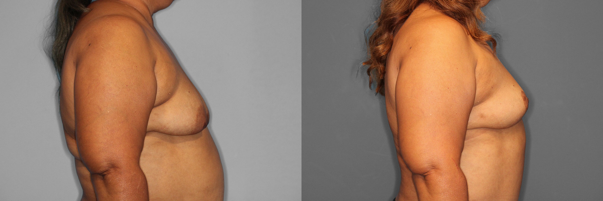 Breast Lift Before and After photo by Dr. Abigail Rodriguez in Houston, TX