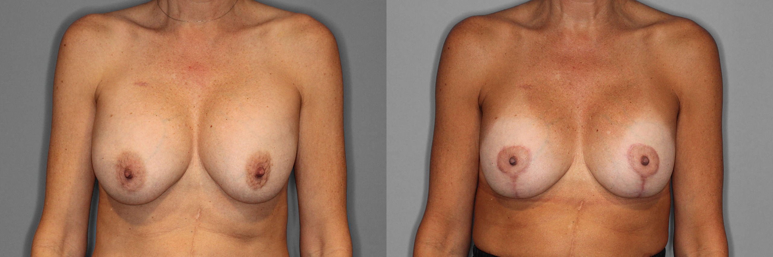 Breast Revision Before and After photo by Dr. Abigail Rodriguez in Houston, TX