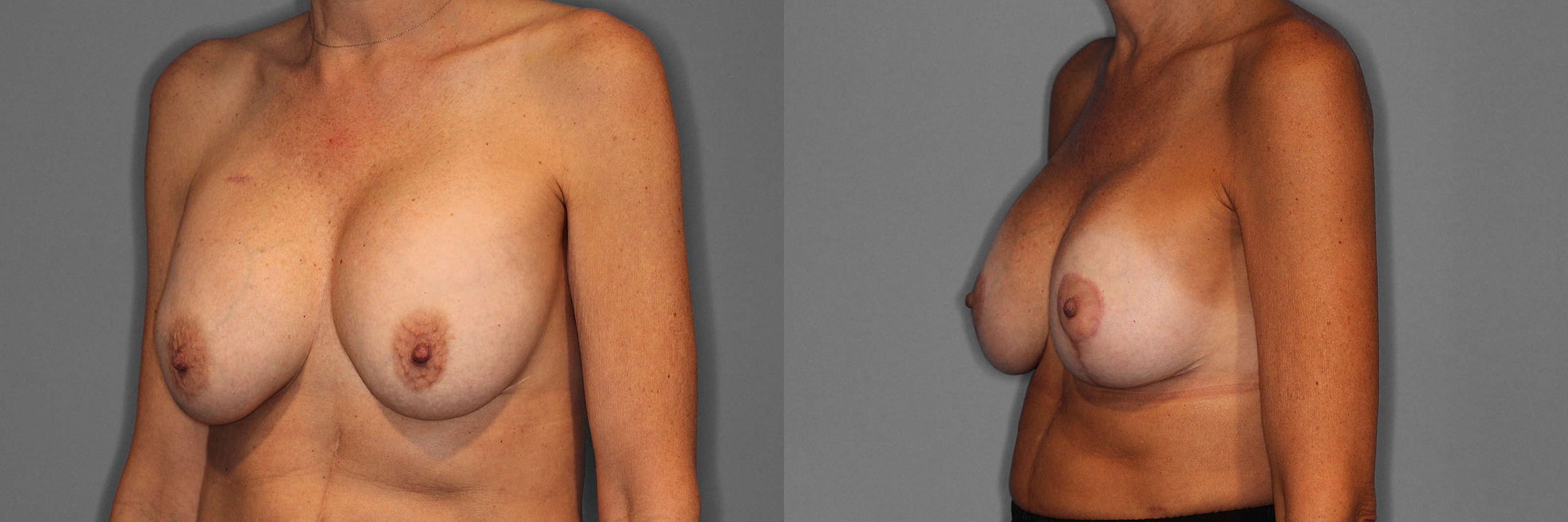 Breast Revision Before and After photo by Dr. Abigail Rodriguez in Houston, TX