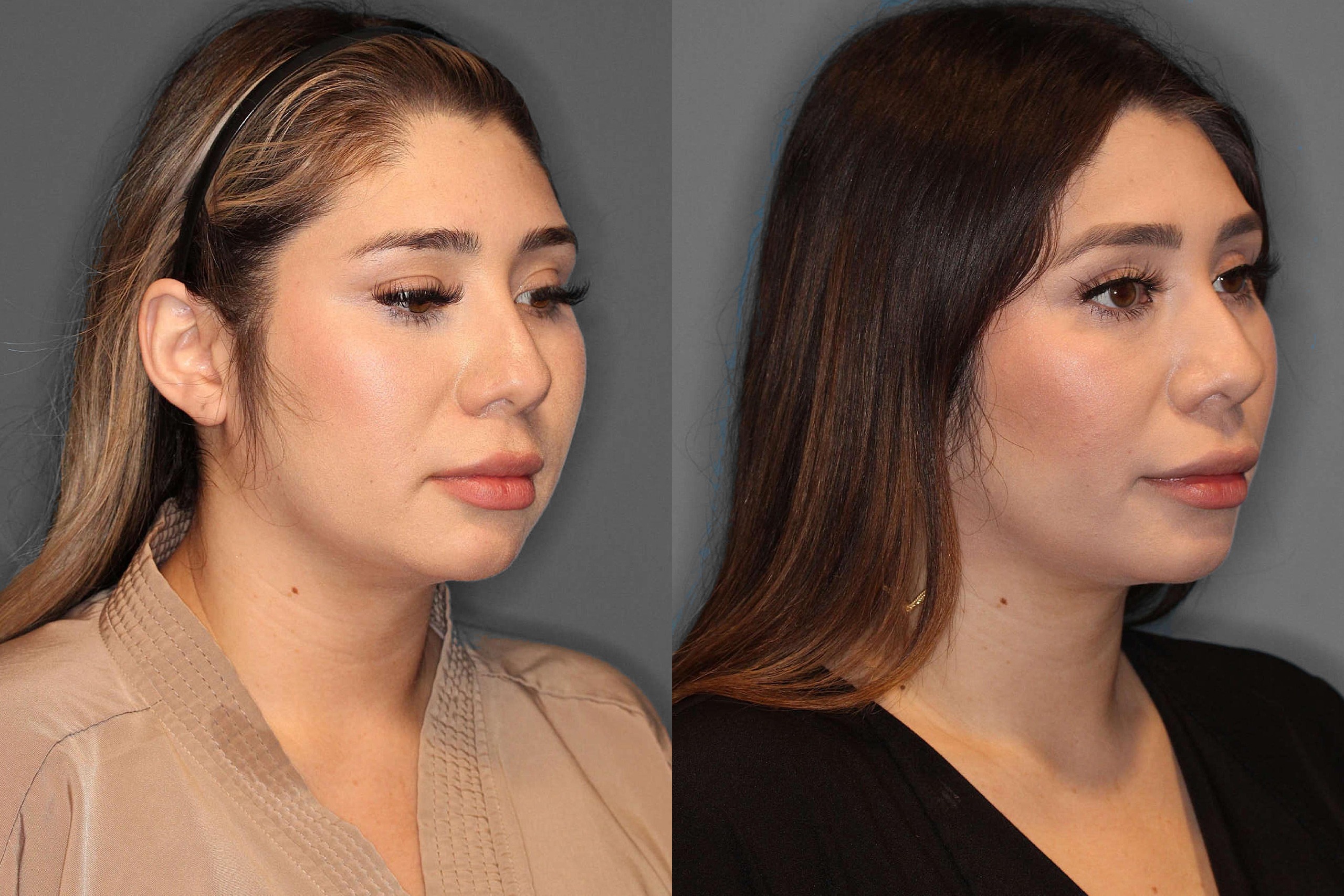 Buccal Fat Pad Removal Before and After photo by Dr. Abigail Rodriguez in Houston, TX