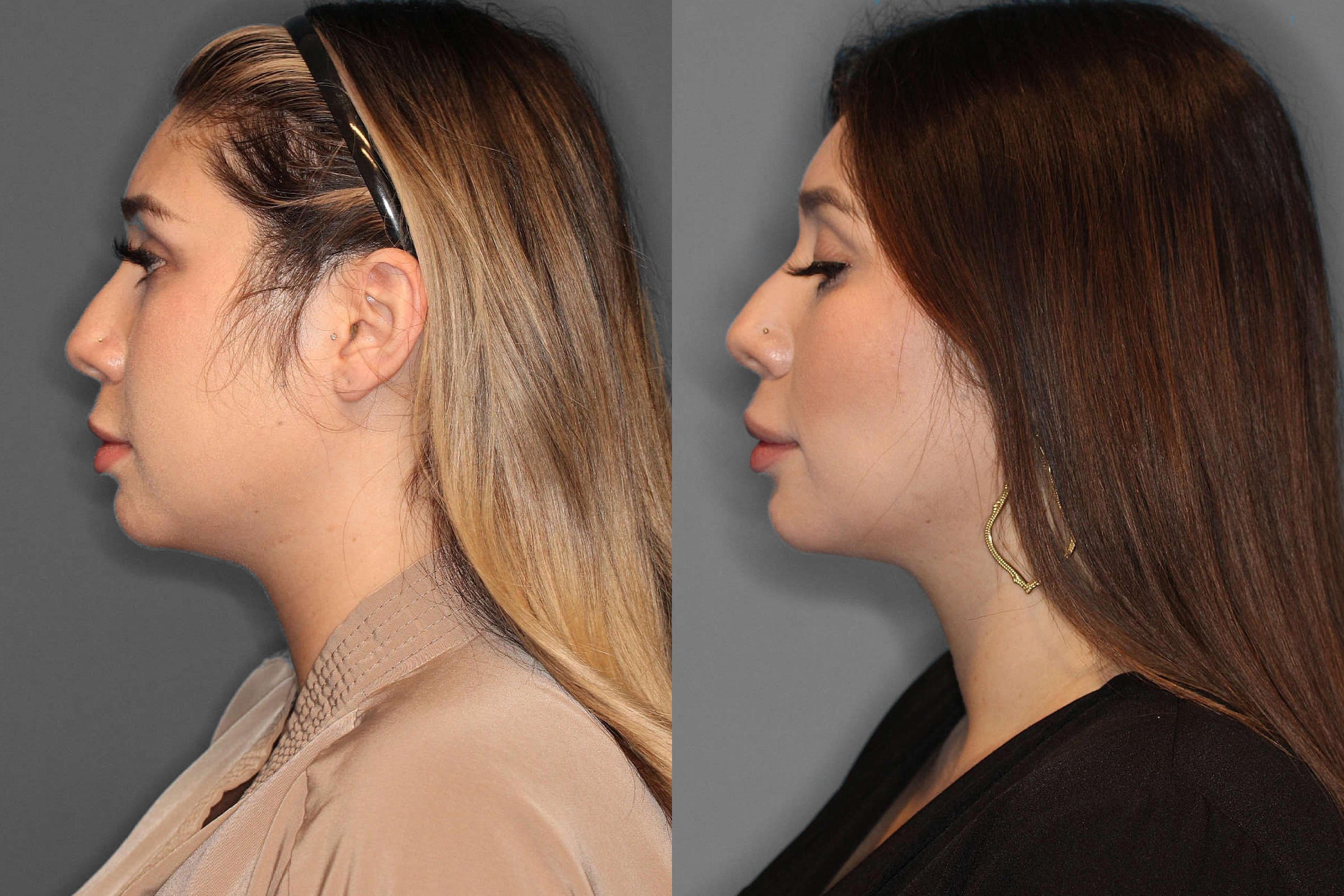 Buccal Fat Pad Removal Before and After photo by Dr. Abigail Rodriguez in Houston, TX