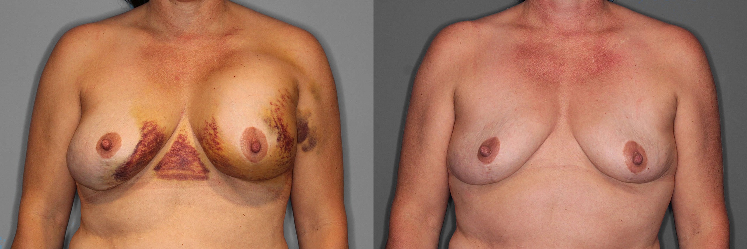 Implant Removal Before and After photo by Dr. Abigail Rodriguez in Houston, TX