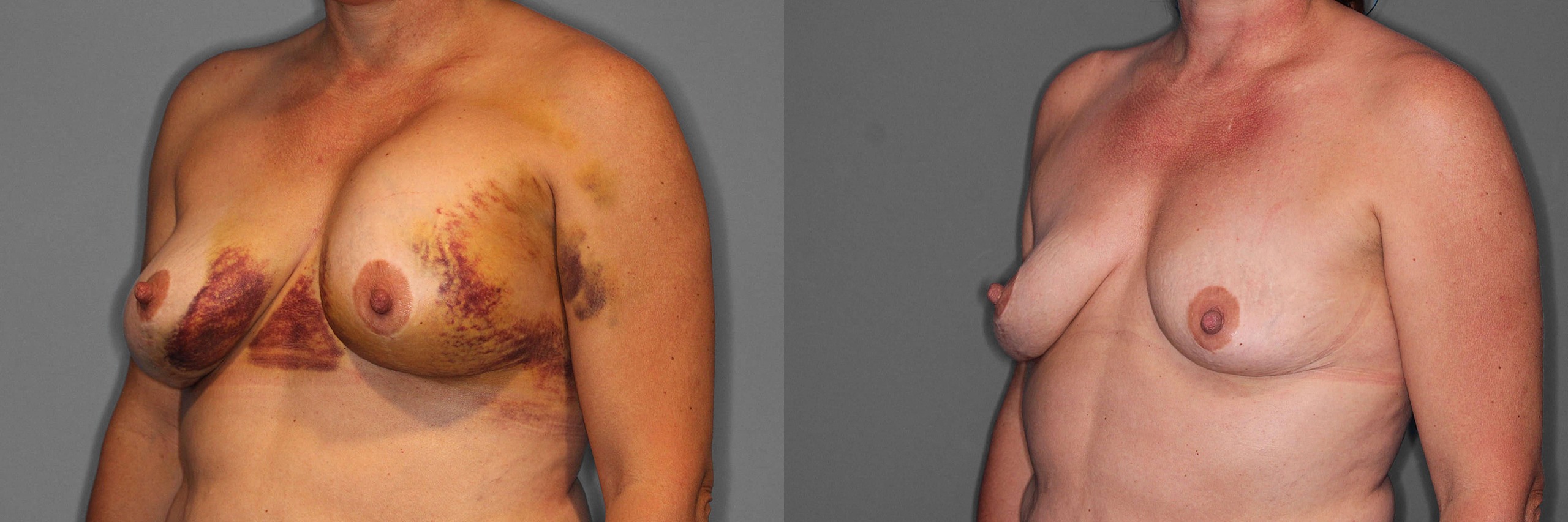 Implant Removal Before and After photo by Dr. Abigail Rodriguez in Houston, TX