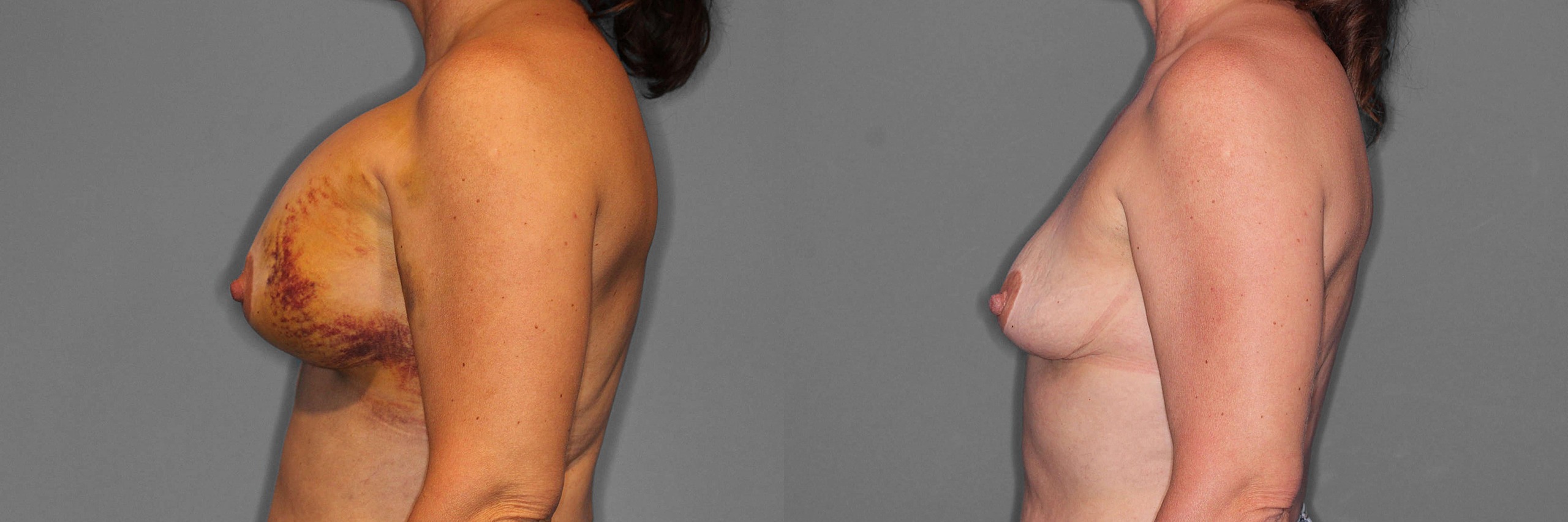 Implant Removal Before and After photo by Dr. Abigail Rodriguez in Houston, TX