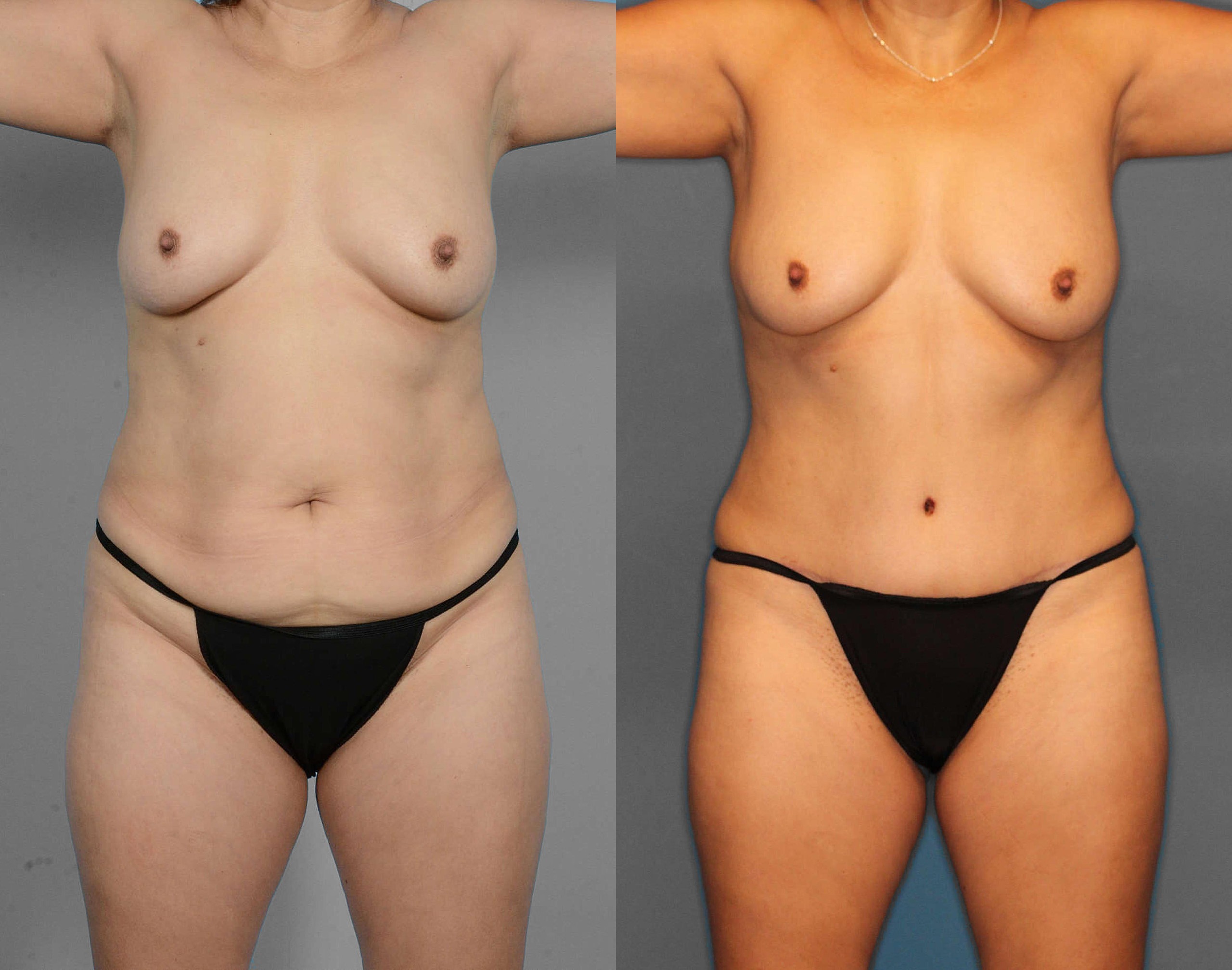 Tummy Tuck Before and After photo by Dr. Abigail Rodriguez in Houston, TX