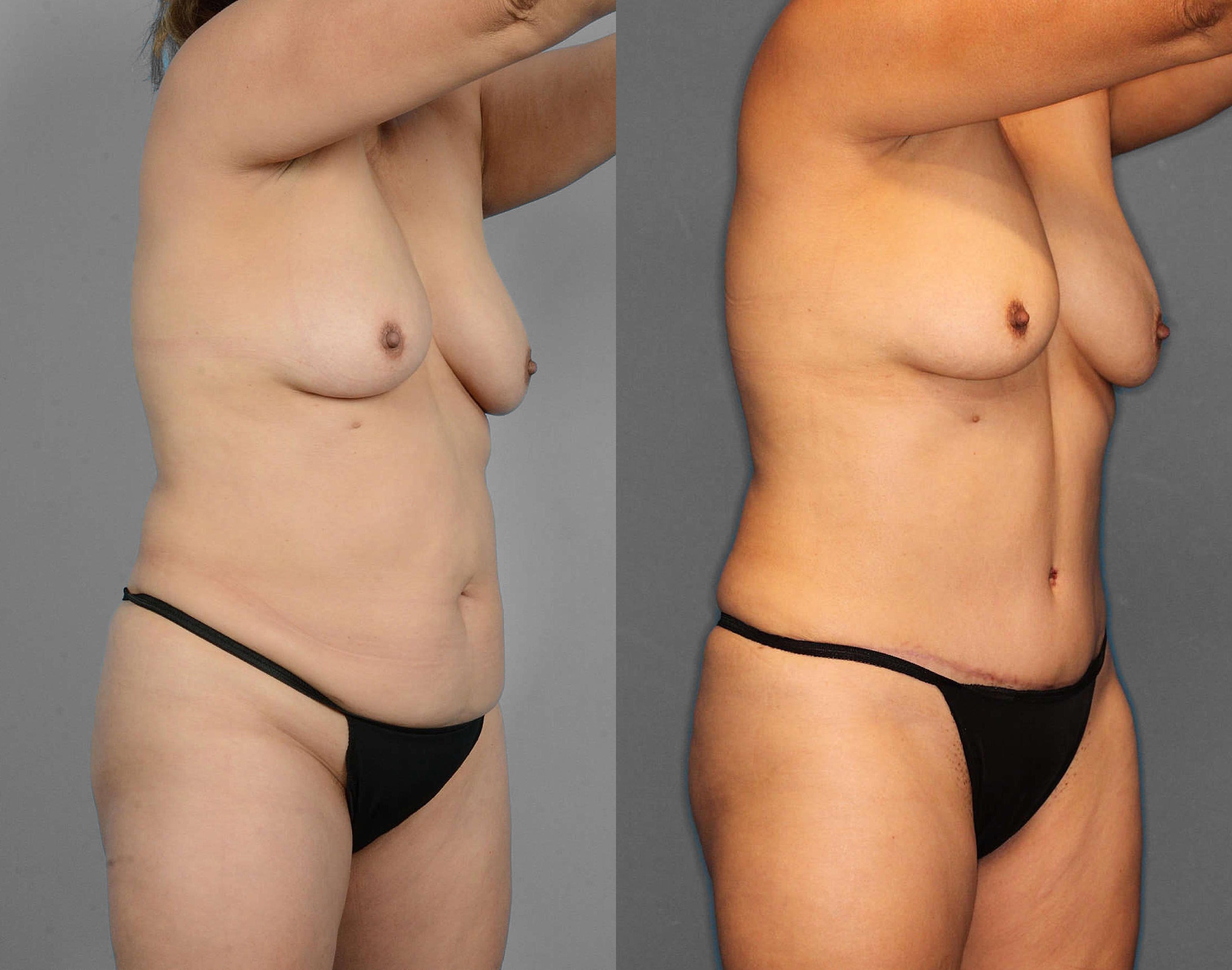 Tummy Tuck Before and After photo by Dr. Abigail Rodriguez in Houston, TX