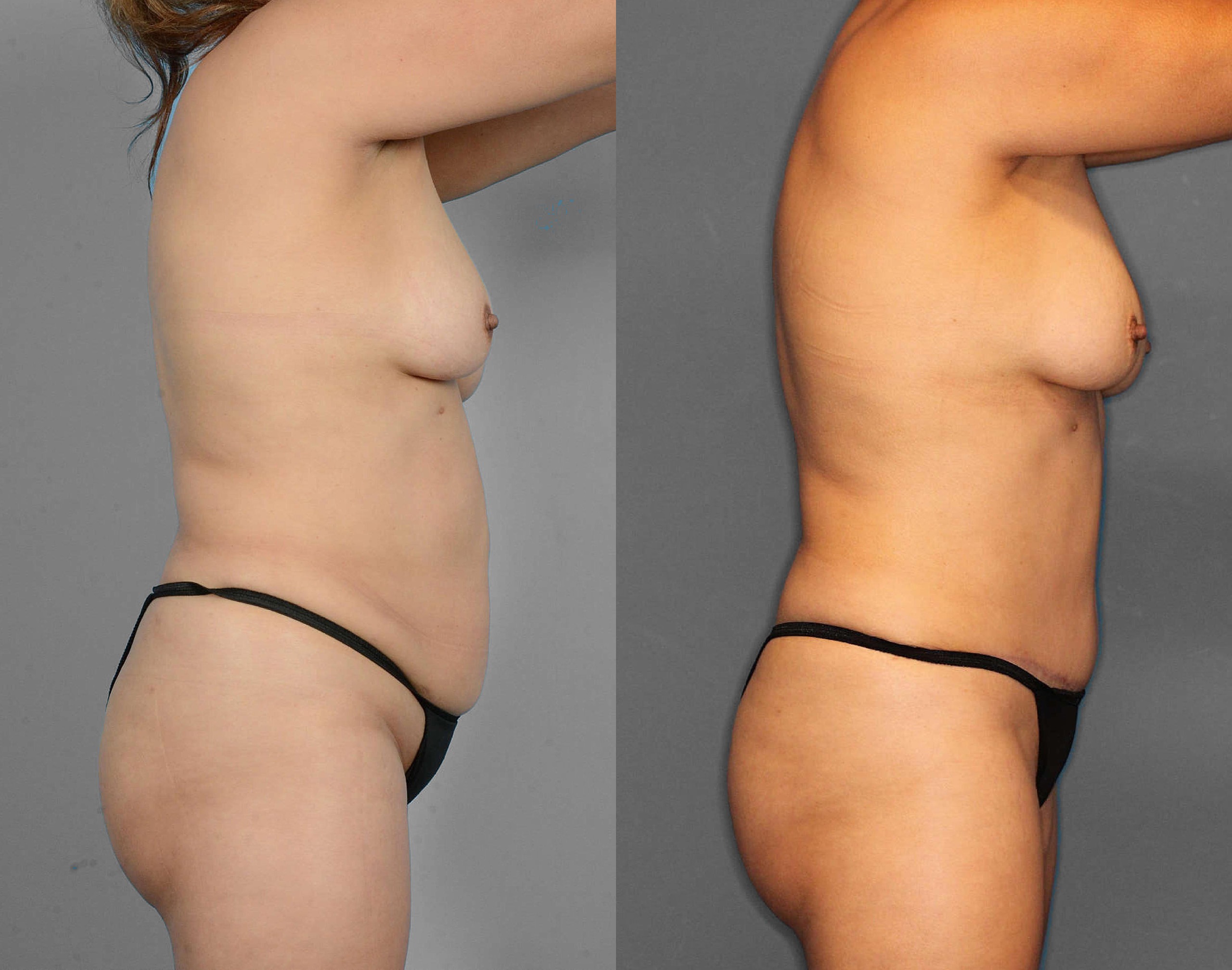 Tummy Tuck Before and After photo by Dr. Abigail Rodriguez in Houston, TX