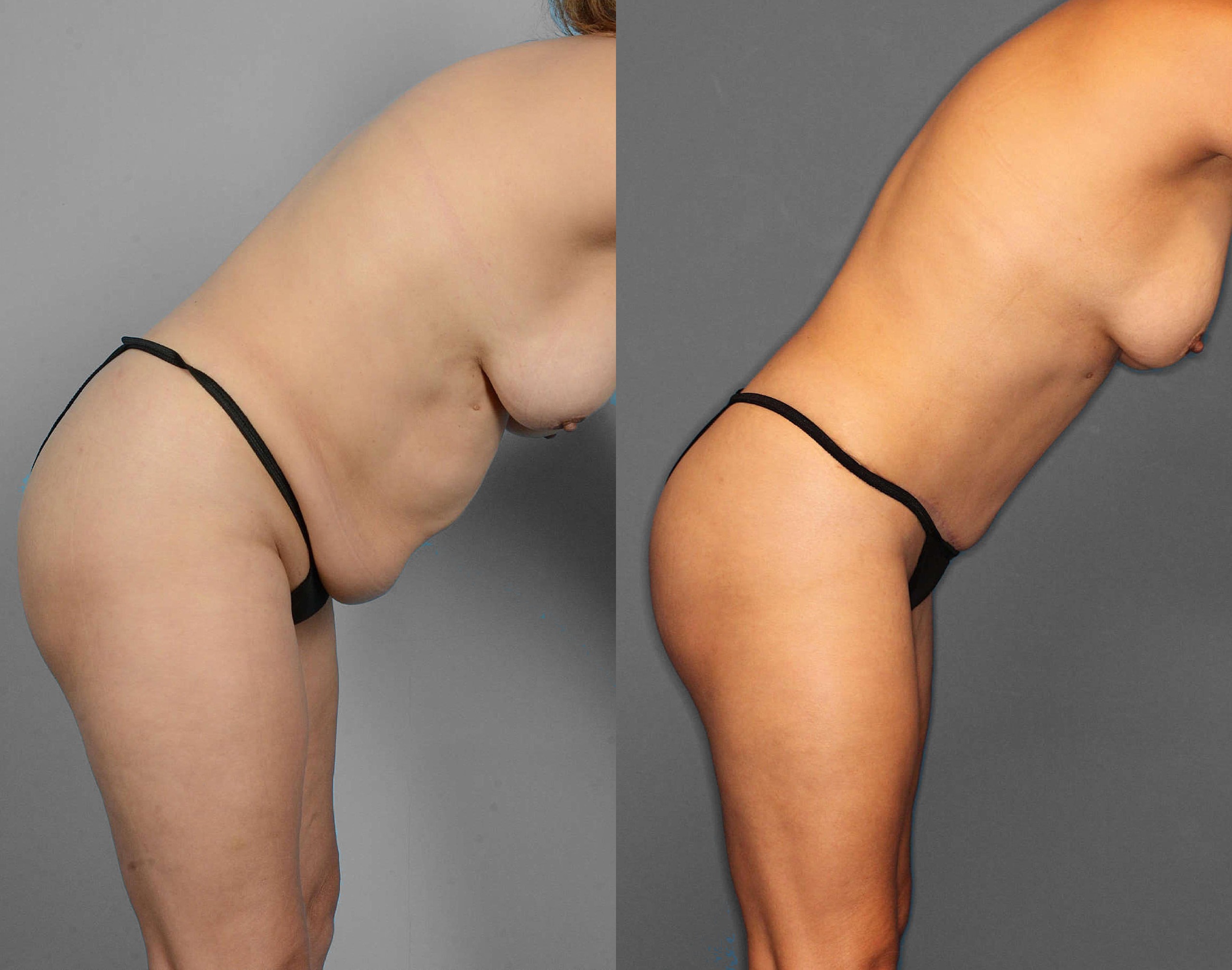 Tummy Tuck Before and After photo by Dr. Abigail Rodriguez in Houston, TX