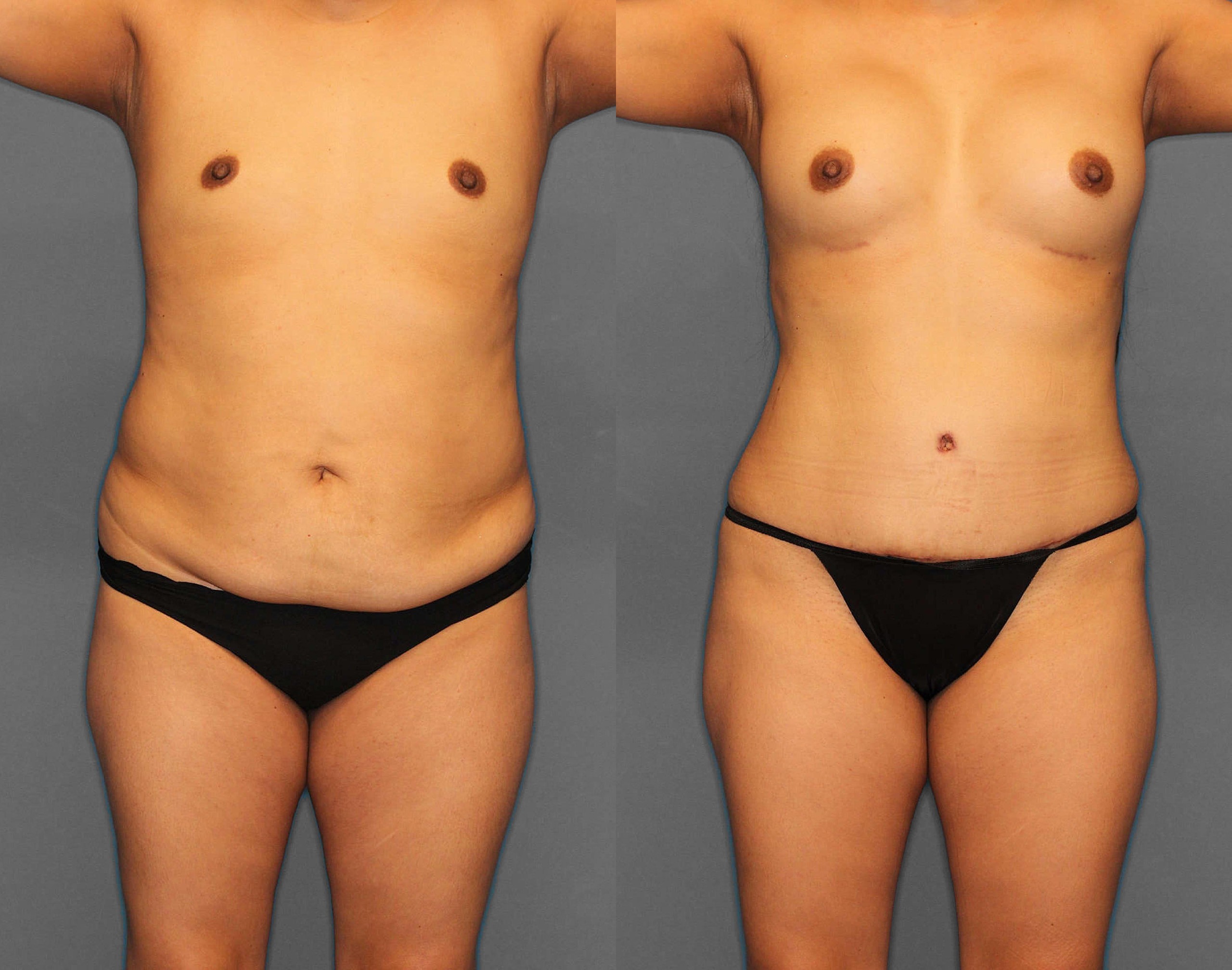 Tummy Tuck:Lipo:BBL Before and After photo by Dr. Abigail Rodriguez in Houston, TX
