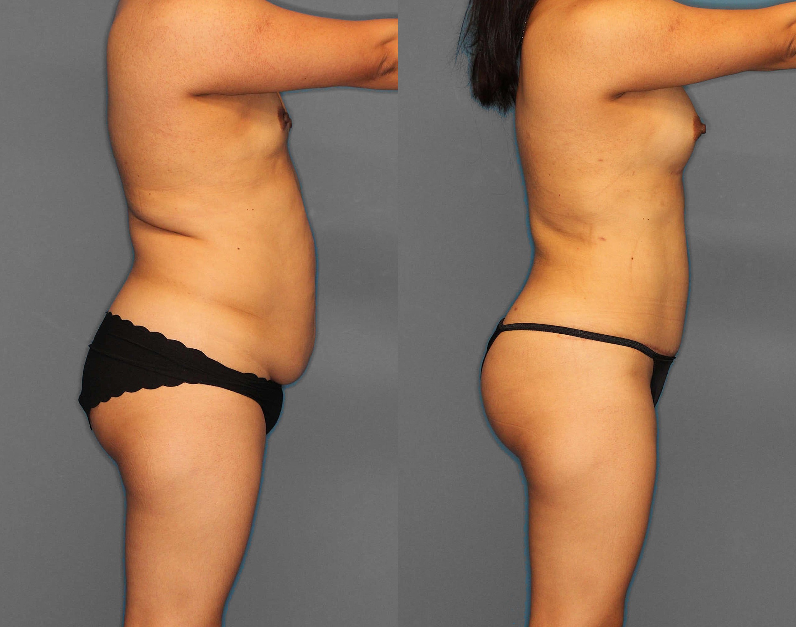 Tummy Tuck:Lipo:BBL Before and After photo by Dr. Abigail Rodriguez in Houston, TX