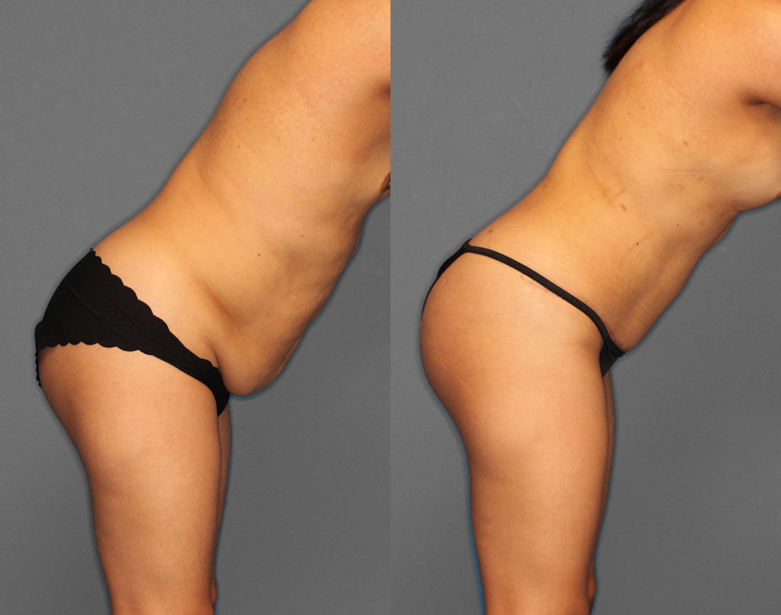 Tummy Tuck:Lipo:BBL Before and After photo by Dr. Abigail Rodriguez in Houston, TX