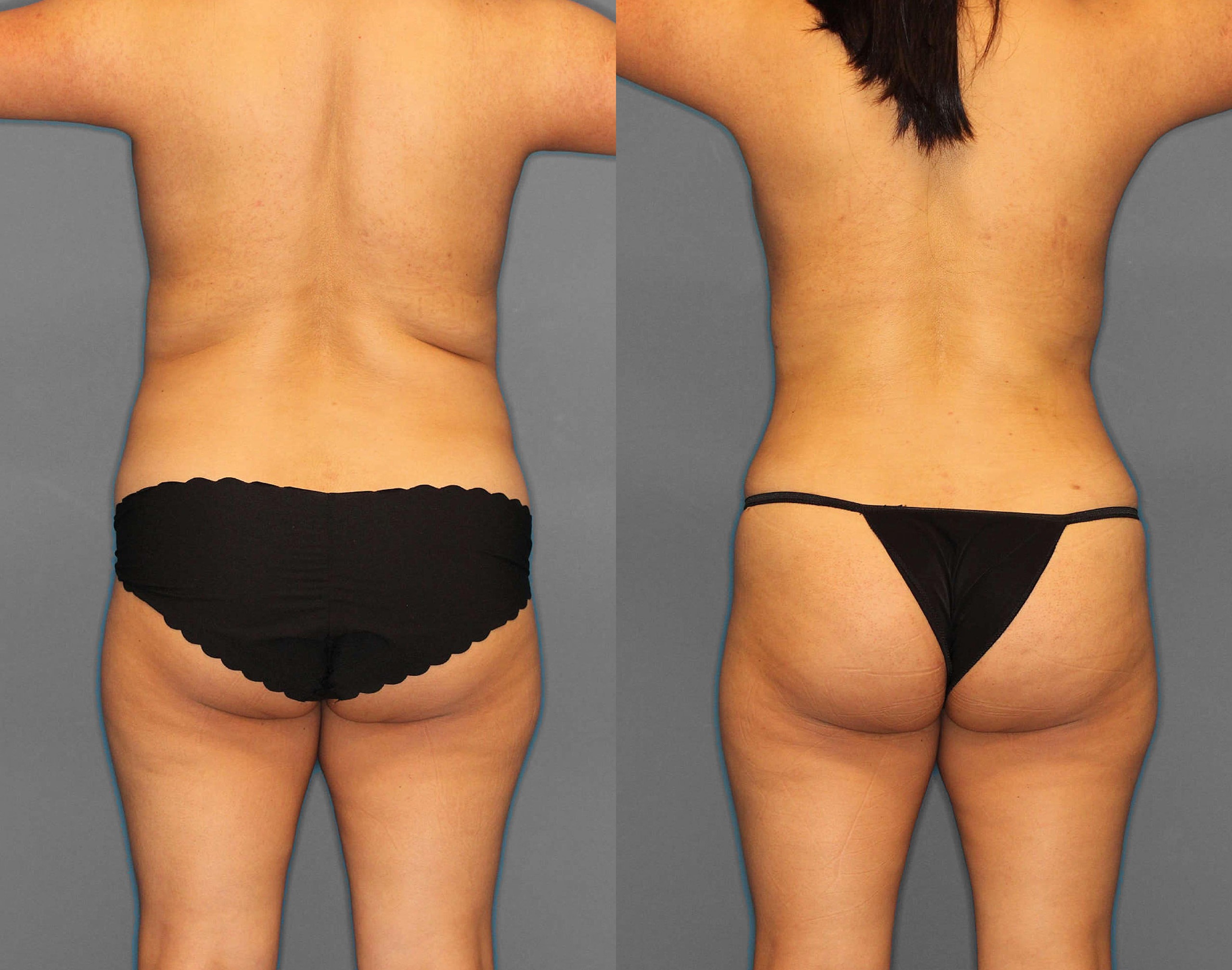 Tummy Tuck:Lipo:BBL Before and After photo by Dr. Abigail Rodriguez in Houston, TX