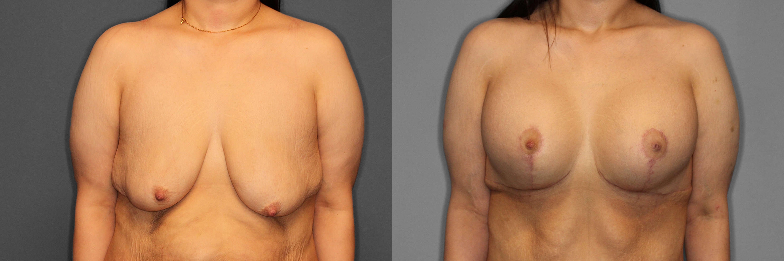 Breast Augmentation:Lift Before and After photo by Dr. Abigail Rodriguez in Houston, TX