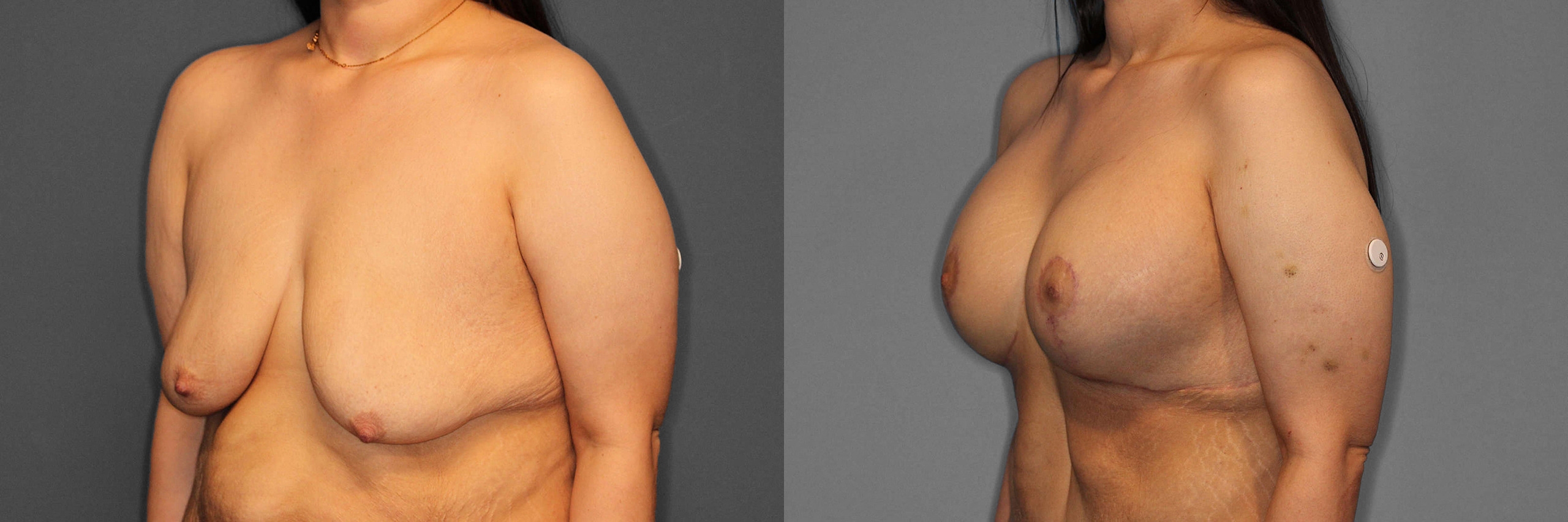Breast Augmentation:Lift Before and After photo by Dr. Abigail Rodriguez in Houston, TX