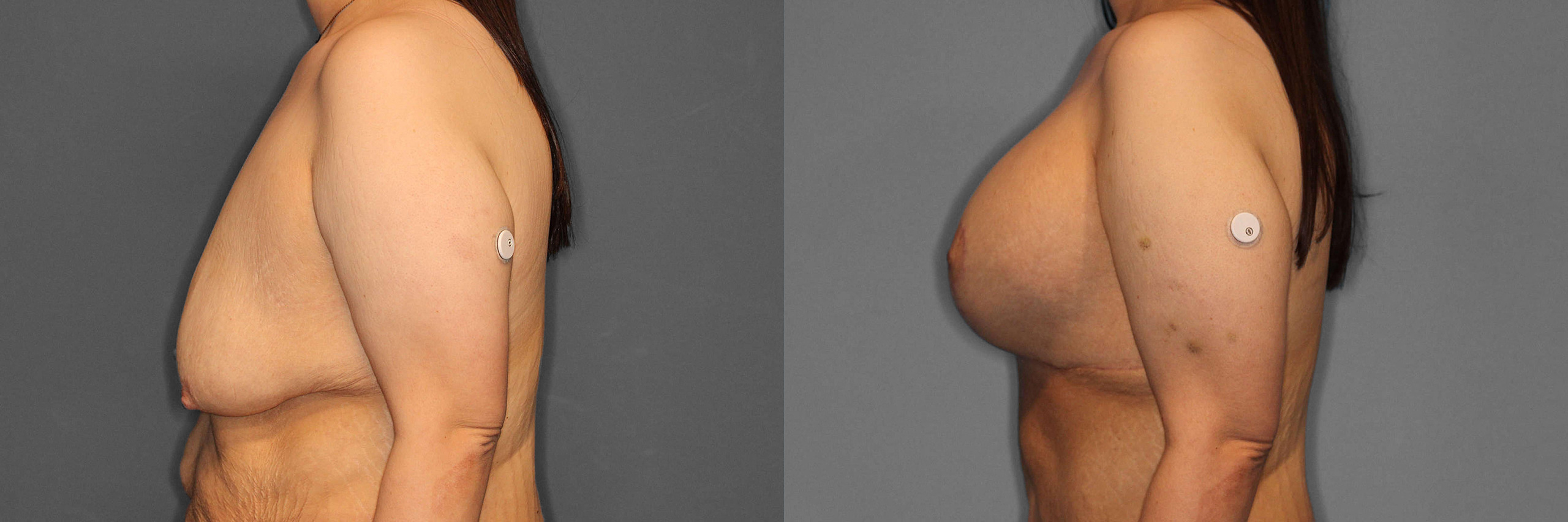 Breast Augmentation:Lift Before and After photo by Dr. Abigail Rodriguez in Houston, TX