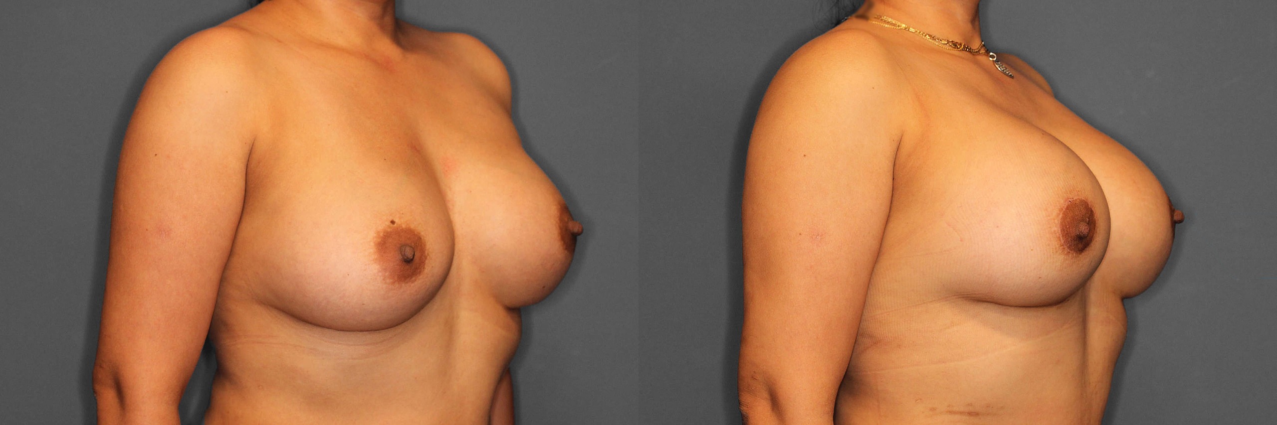 Breast Revision Before and After photo by Dr. Abigail Rodriguez in Houston, TX