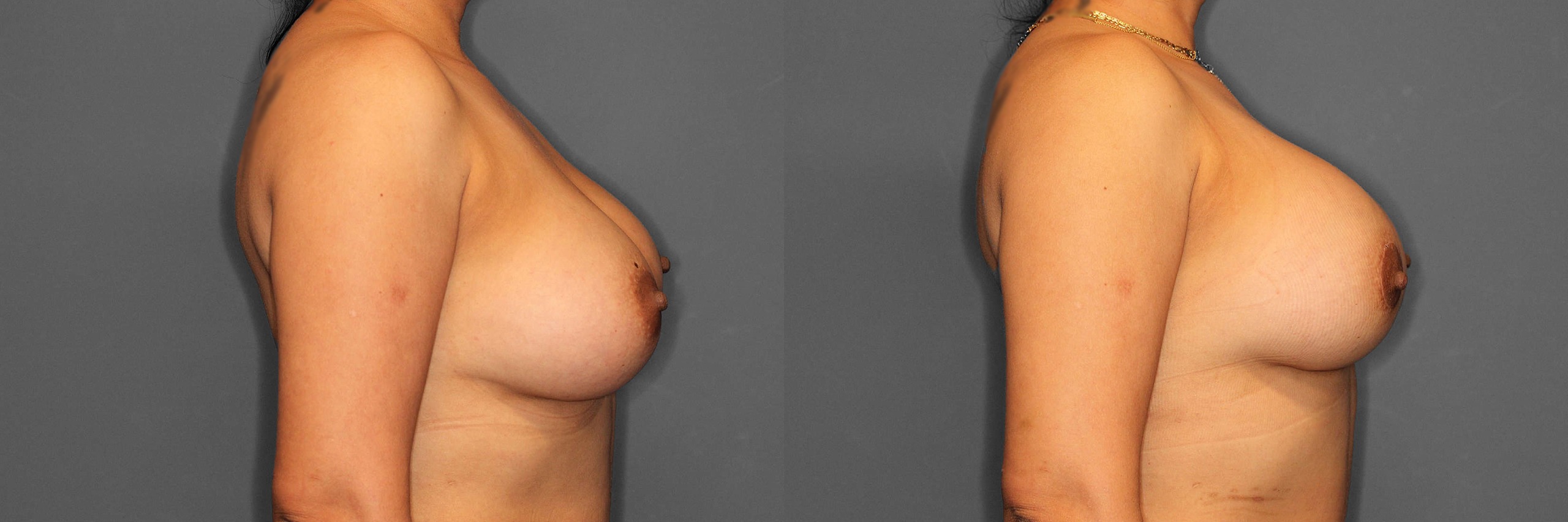 Breast Revision Before and After photo by Dr. Abigail Rodriguez in Houston, TX