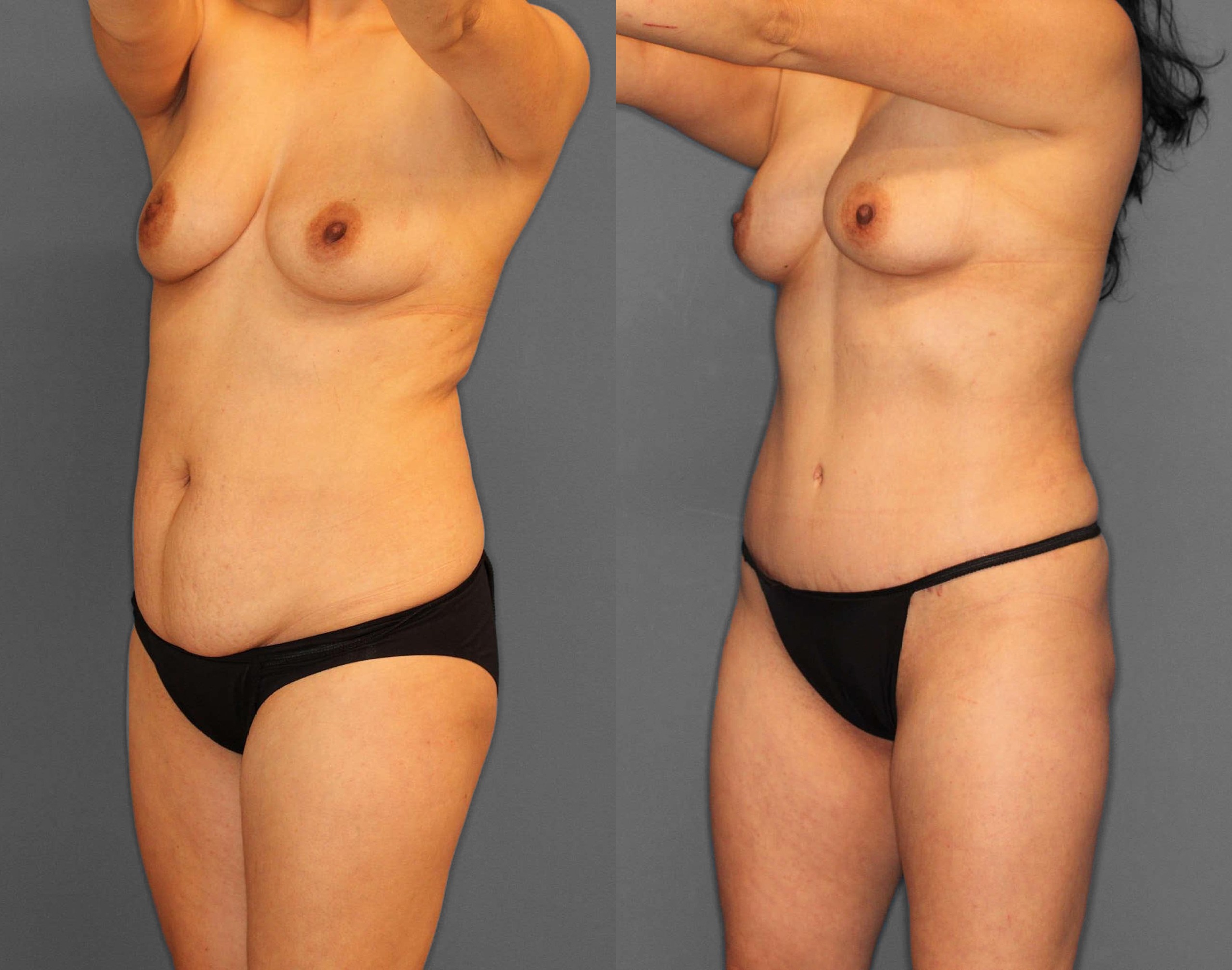 Liposuction:Tummy Tuck Before and After photo by Dr. Abigail Rodriguez in Houston, TX
