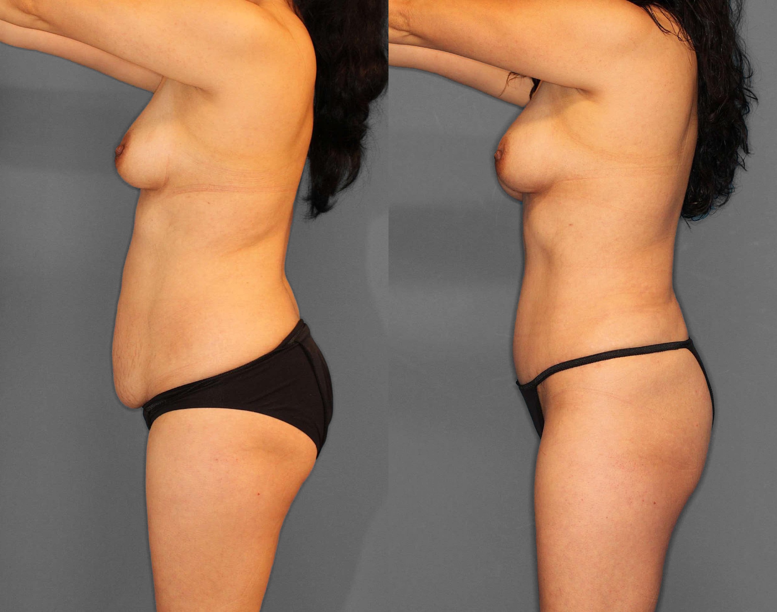 Liposuction:Tummy Tuck Before and After photo by Dr. Abigail Rodriguez in Houston, TX