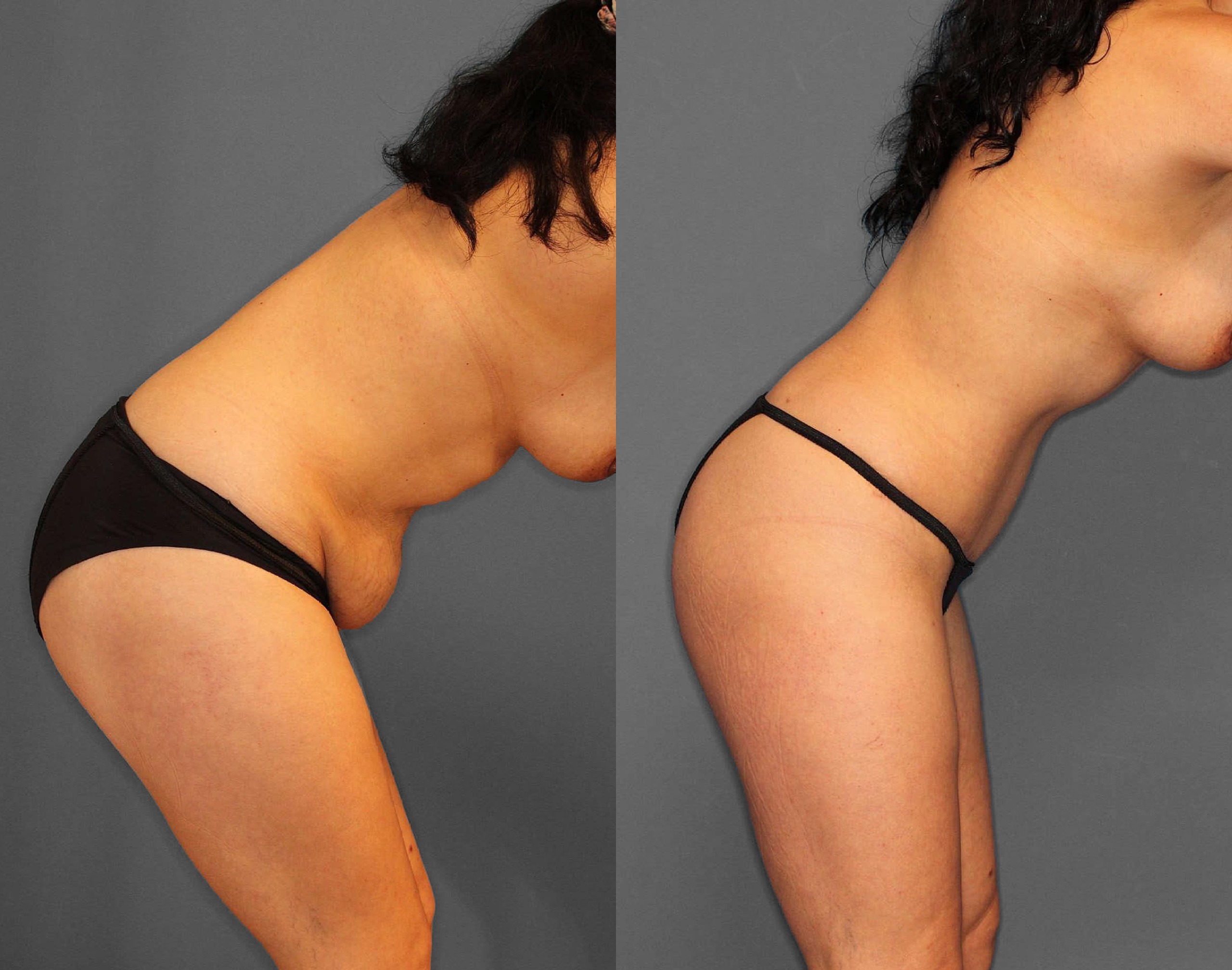 Liposuction:Tummy Tuck Before and After photo by Dr. Abigail Rodriguez in Houston, TX