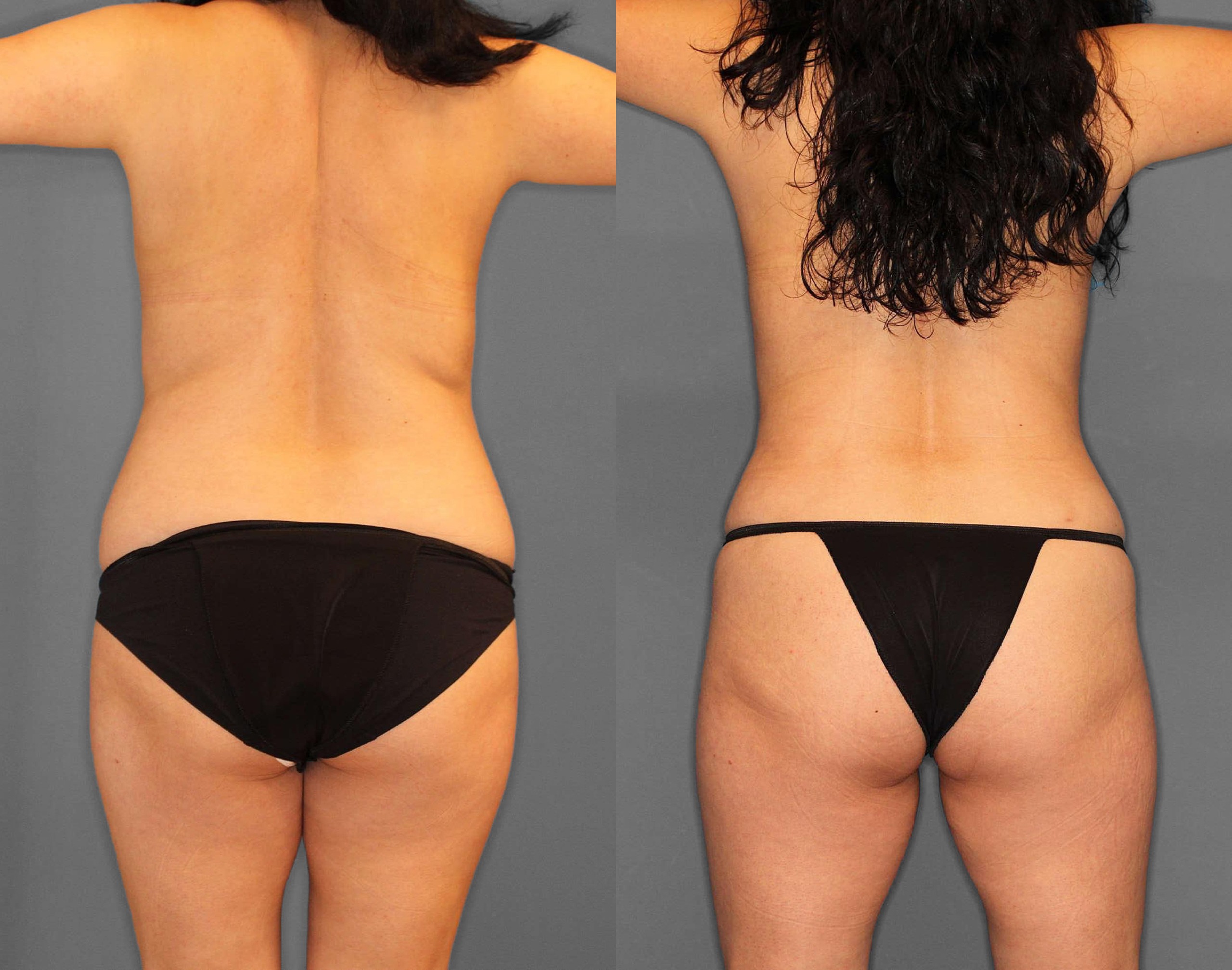 Liposuction:Tummy Tuck Before and After photo by Dr. Abigail Rodriguez in Houston, TX