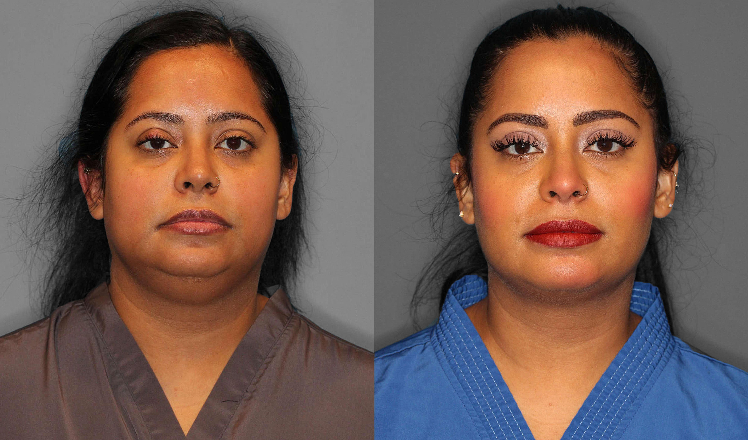 Neck Liposuction:Buccal Fat Before and After photo by Dr. Abigail Rodriguez in Houston, TX
