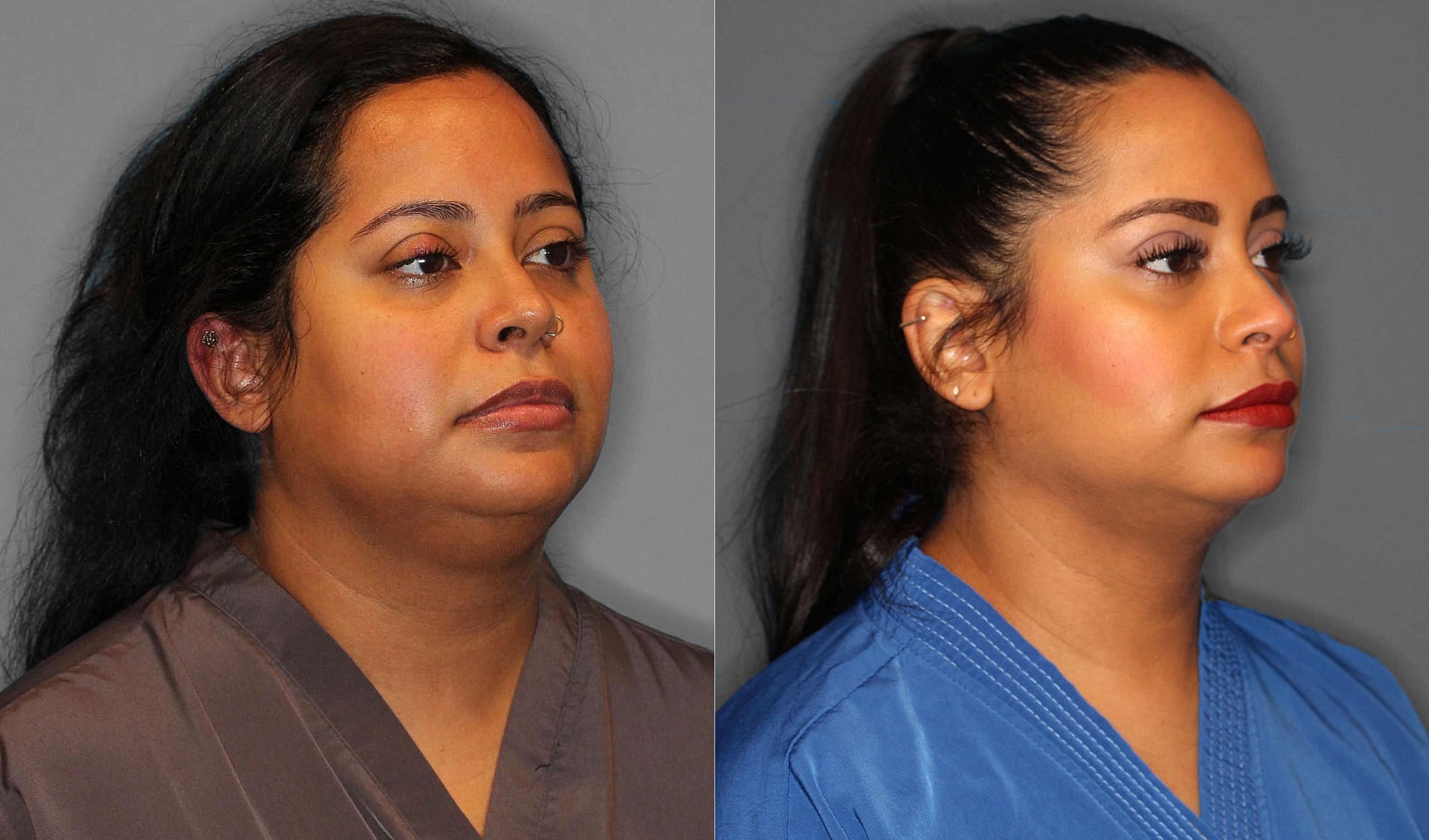 Neck Liposuction:Buccal Fat Before and After photo by Dr. Abigail Rodriguez in Houston, TX