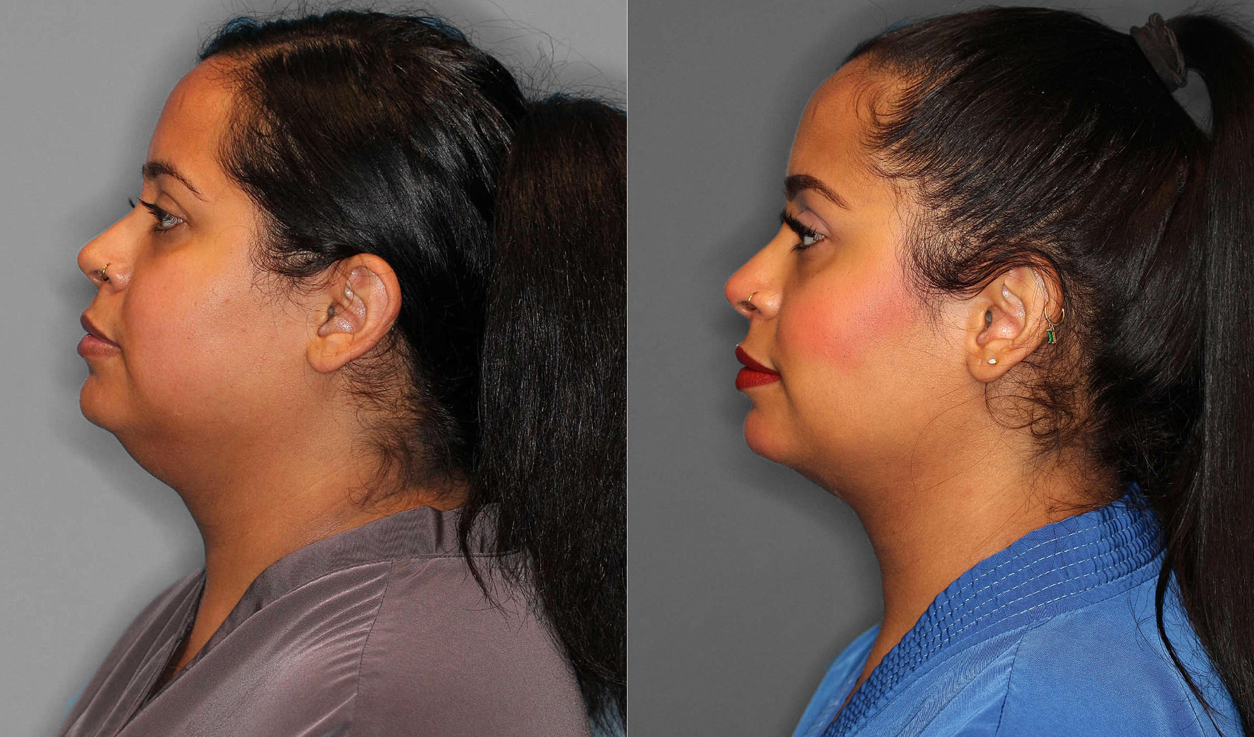 Neck Liposuction:Buccal Fat Before and After photo by Dr. Abigail Rodriguez in Houston, TX