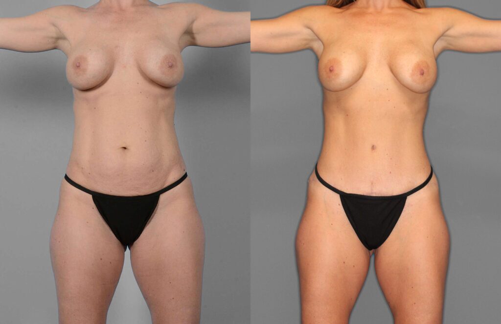 Tummy Tuck Before and After photo by Dr. Abigail Rodriguez in Houston, TX