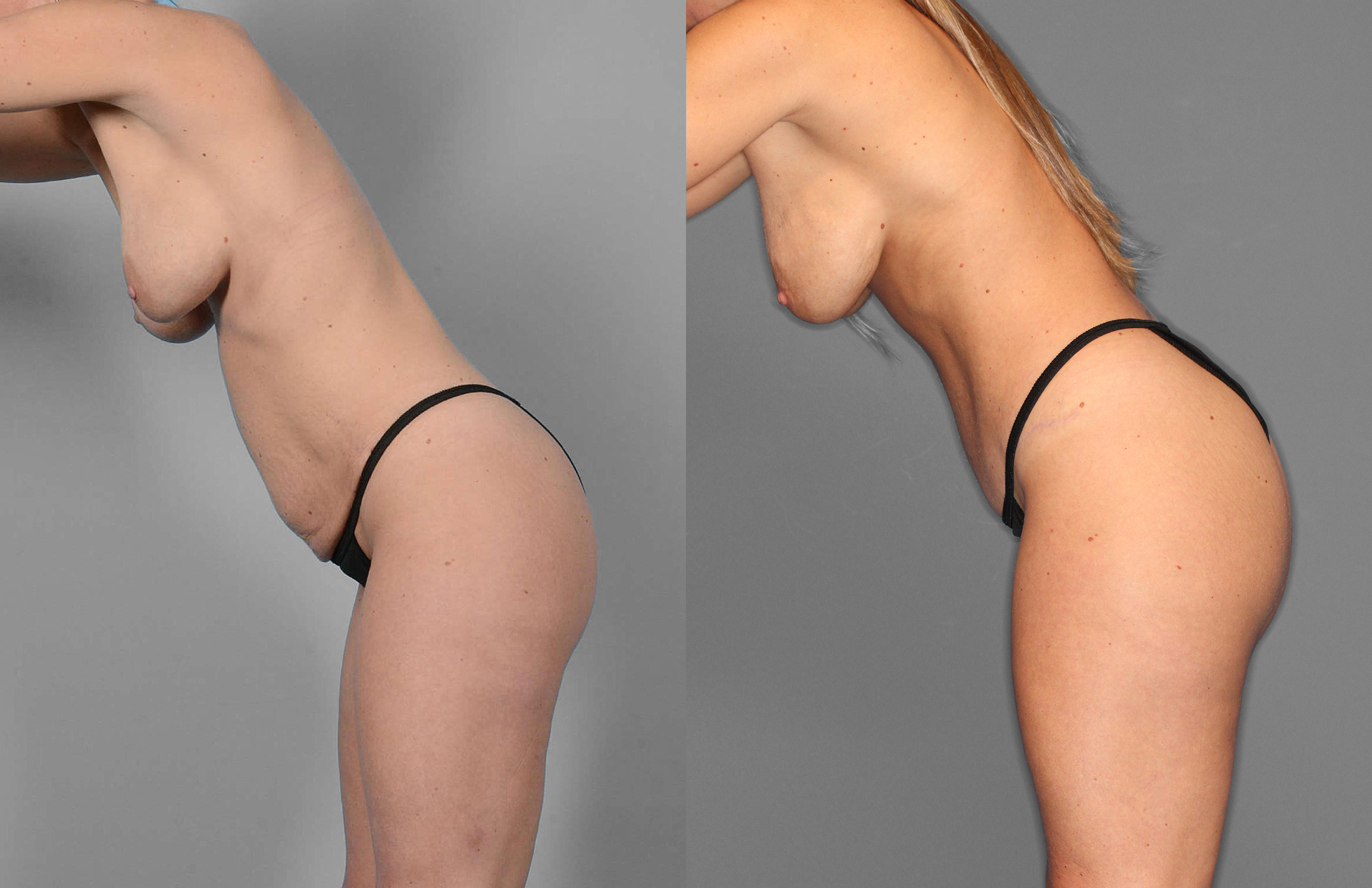 Tummy Tuck Before and After photo by Dr. Abigail Rodriguez in Houston, TX