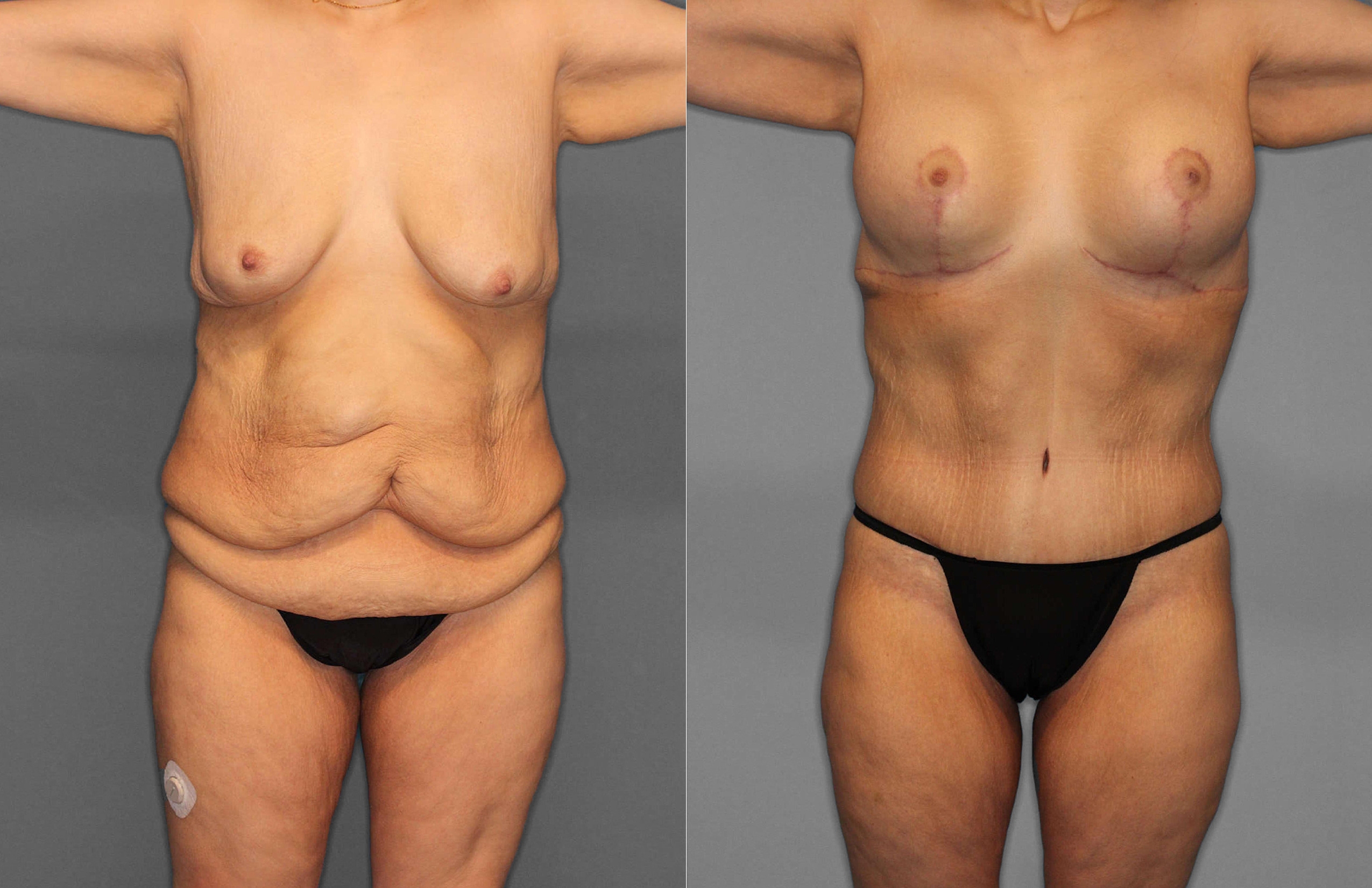 Tummy Tuck Before and After photo by Dr. Abigail Rodriguez in Houston, TX