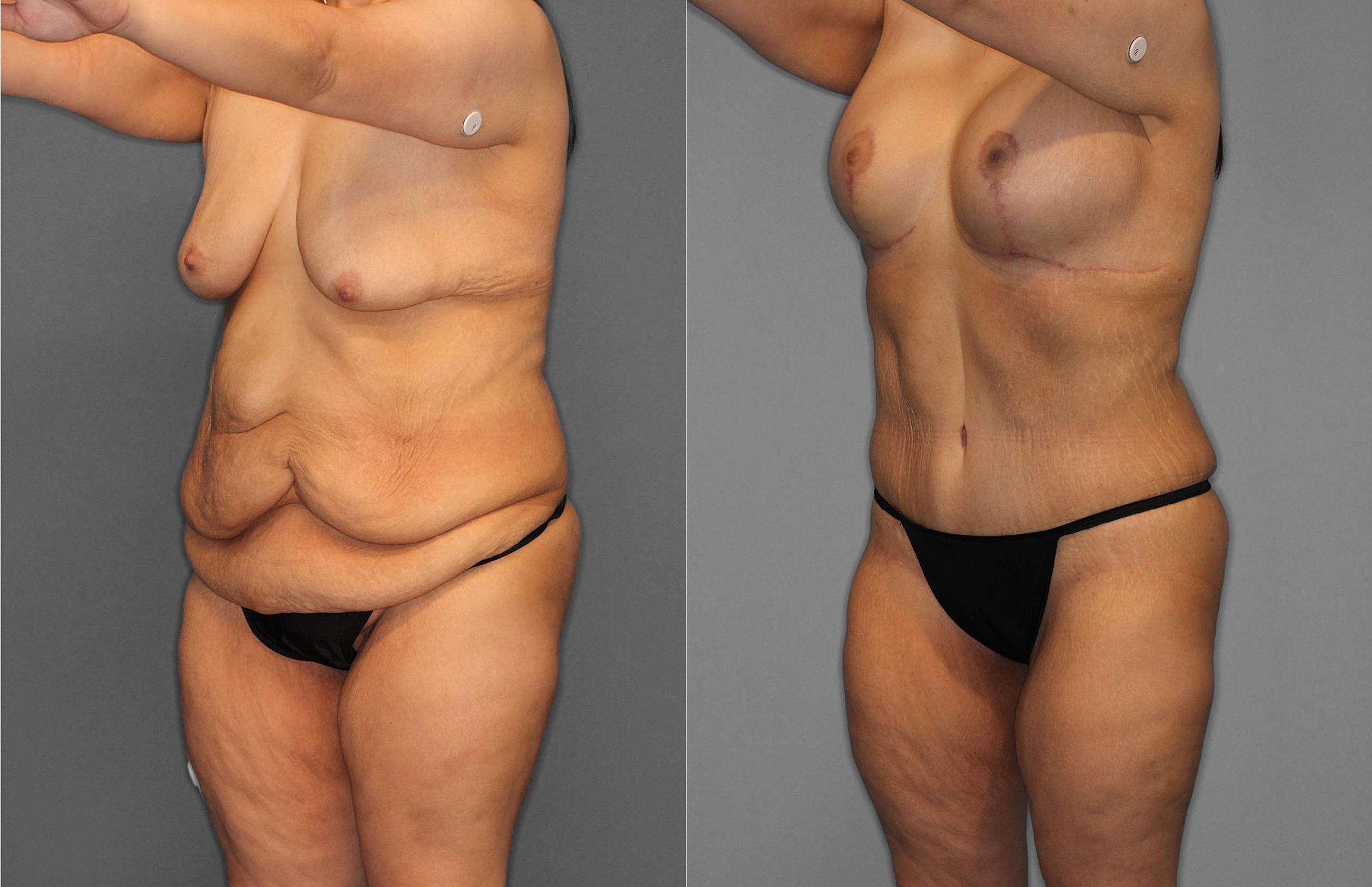 Tummy Tuck Before and After photo by Dr. Abigail Rodriguez in Houston, TX