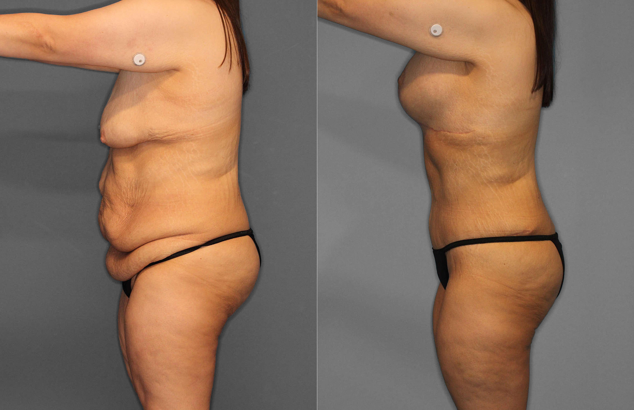 Tummy Tuck Before and After photo by Dr. Abigail Rodriguez in Houston, TX
