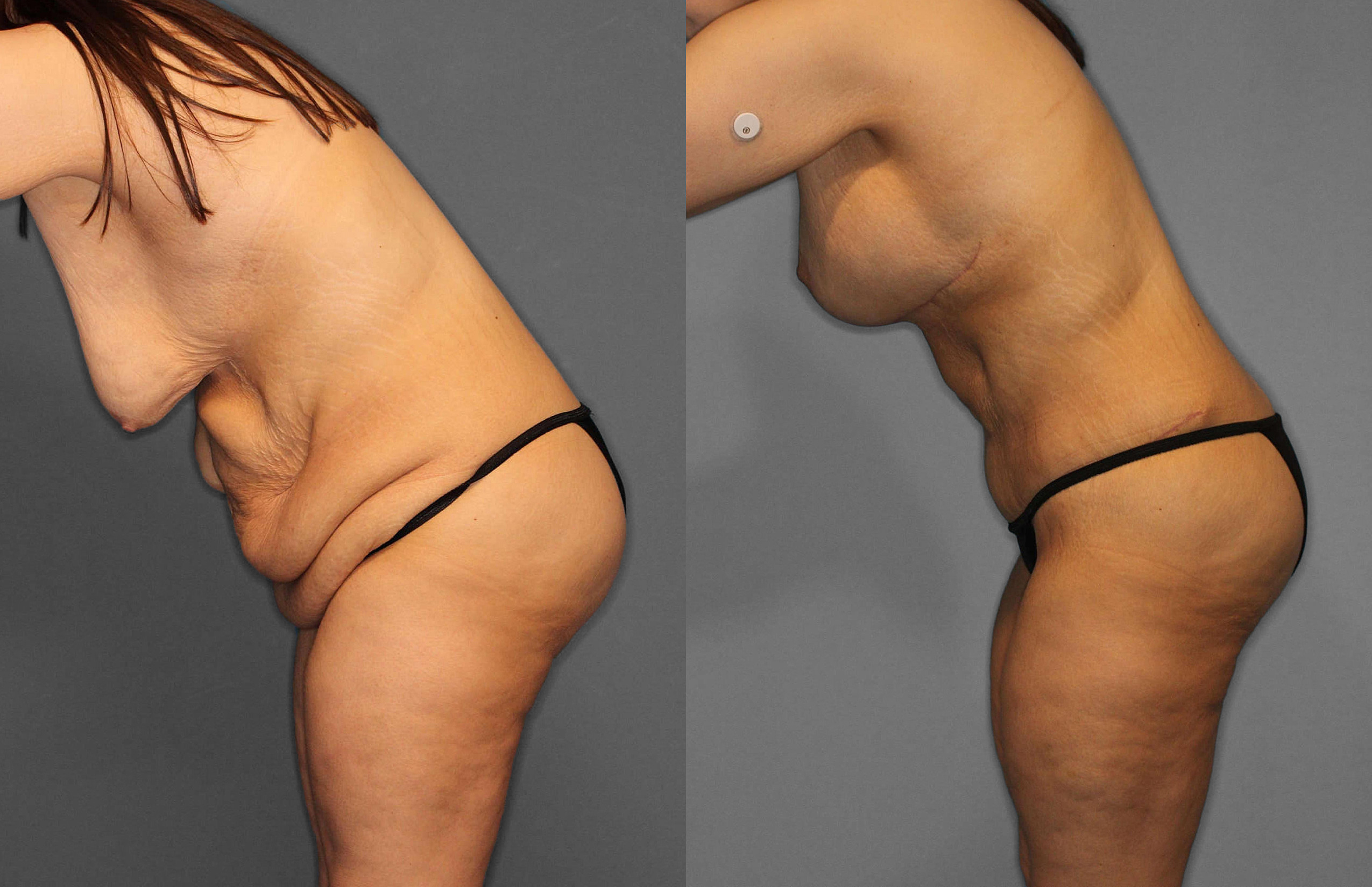 Tummy Tuck Before and After photo by Dr. Abigail Rodriguez in Houston, TX