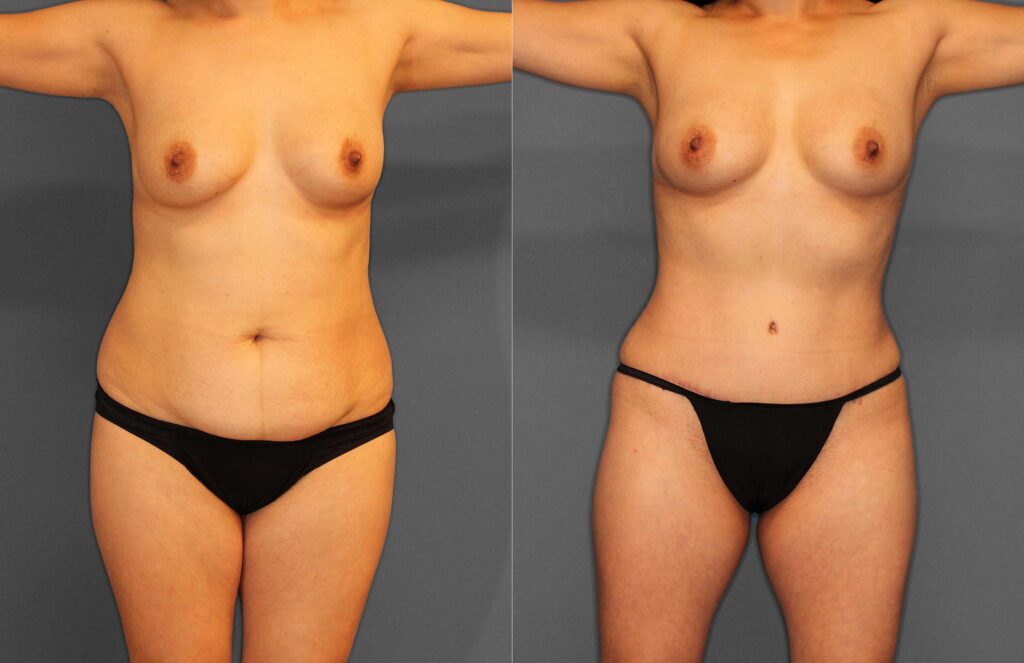 Tummy Tuck:Liposuction Before and After photo by Dr. Abigail Rodriguez in Houston, TX